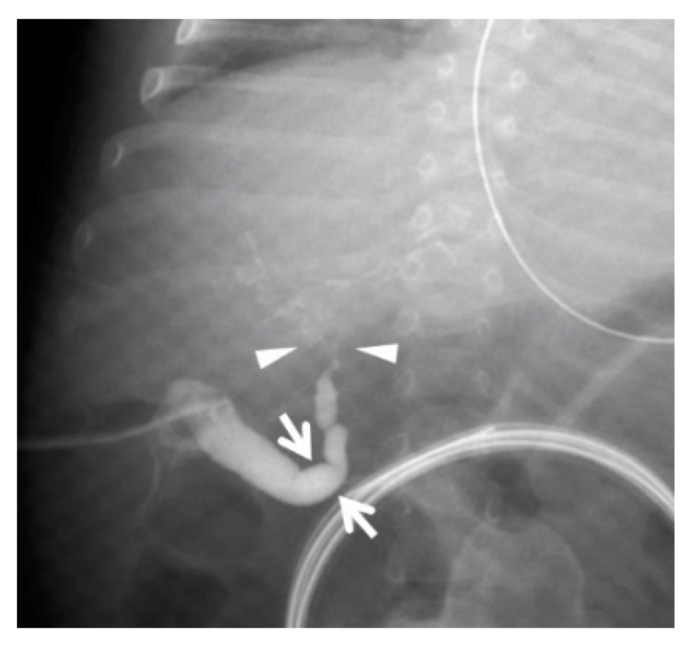 Pediatric Reports | Free Full-Text | Diagnostic Significance of Absence ...