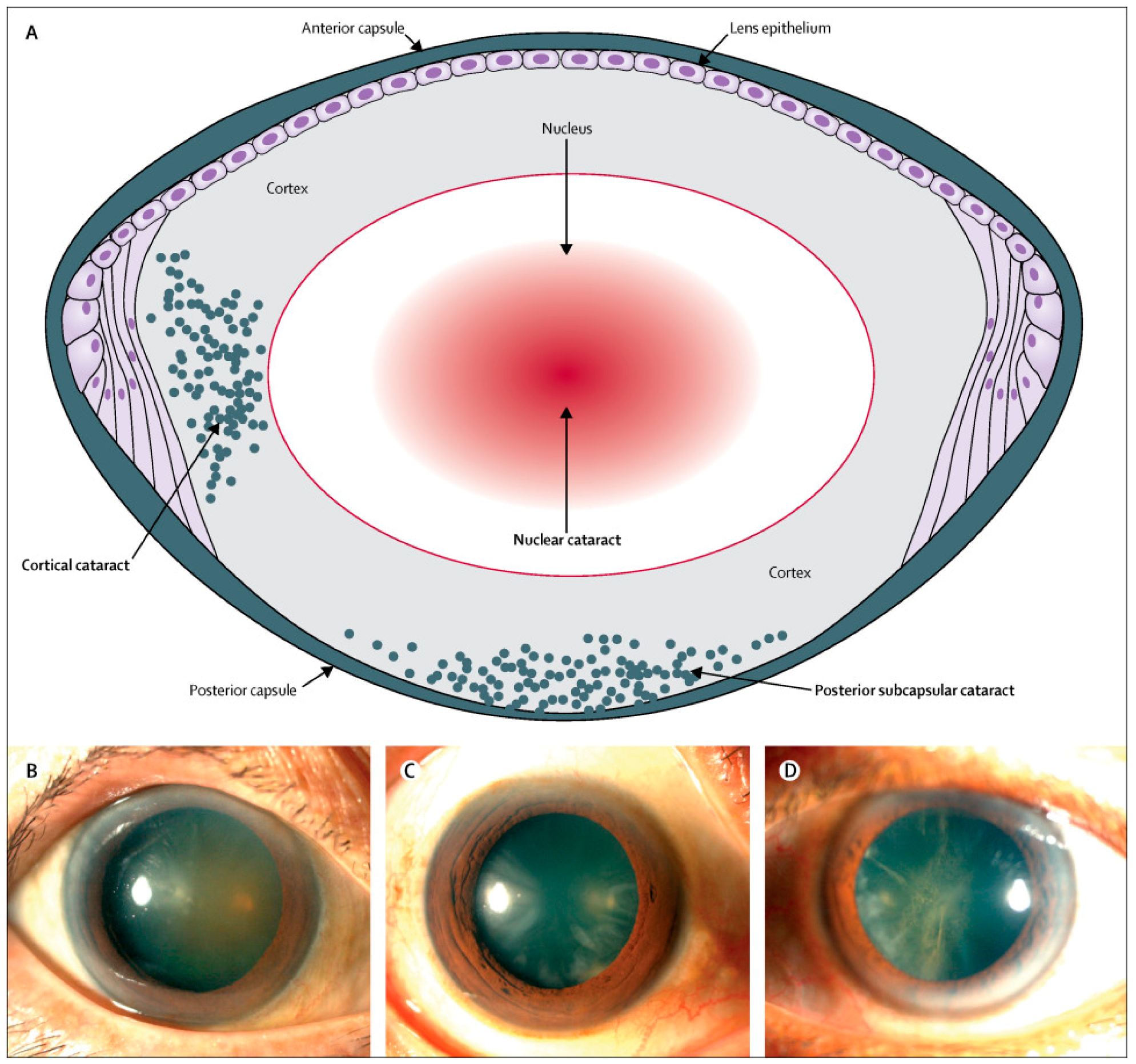 Pharmaceuticals | Free Full-Text | Current Trends in the Pharmacotherapy of  Cataracts