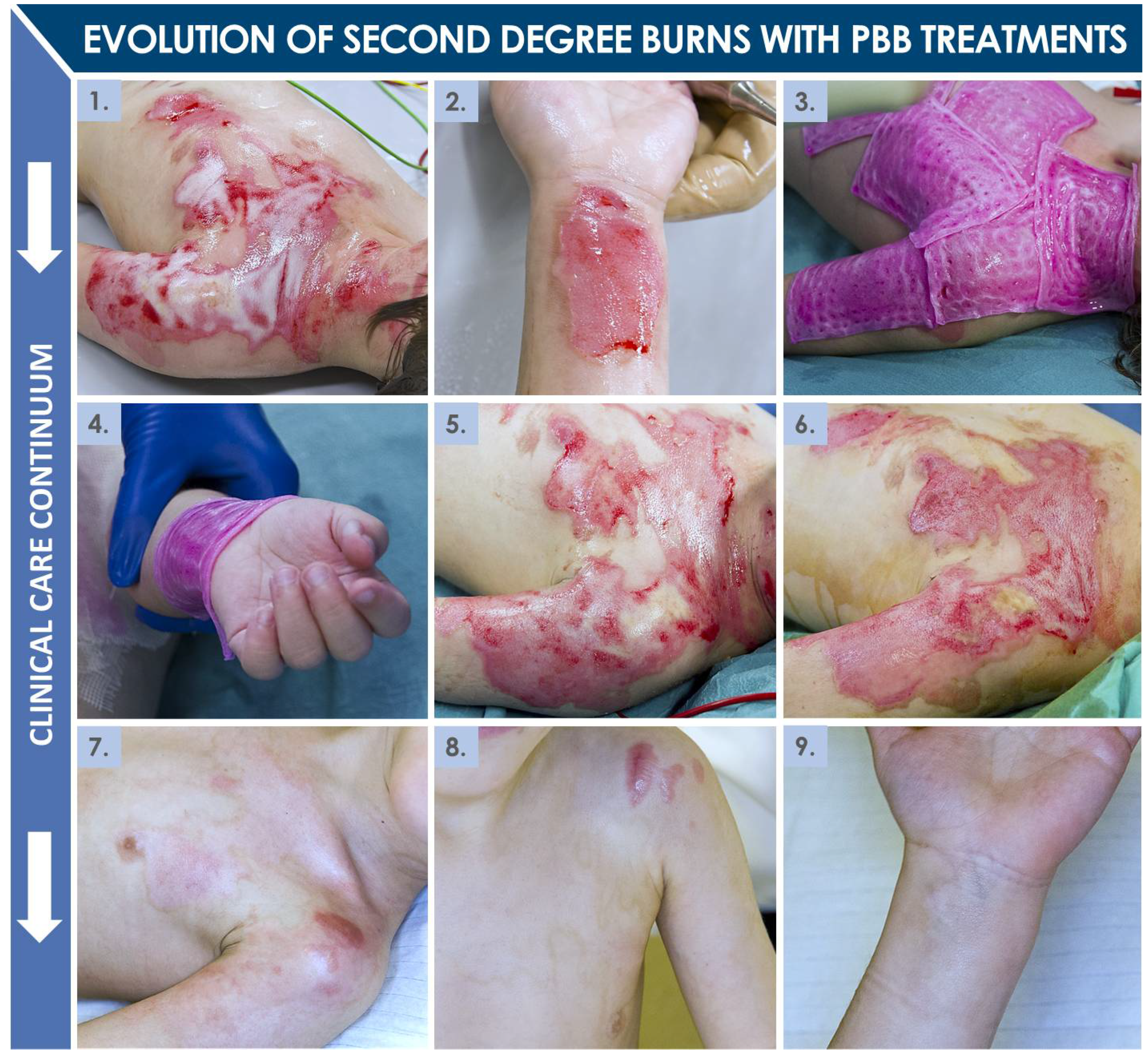 Pharmaceuticals Free Full Text Retrospective Evaluation Of Progenitor Biological Bandage Use A Complementary And Safe Therapeutic Management Option For Prevention Of Hypertrophic Scarring In Pediatric Burn Care Html