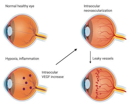 Angiogenesis and ocular diseases
