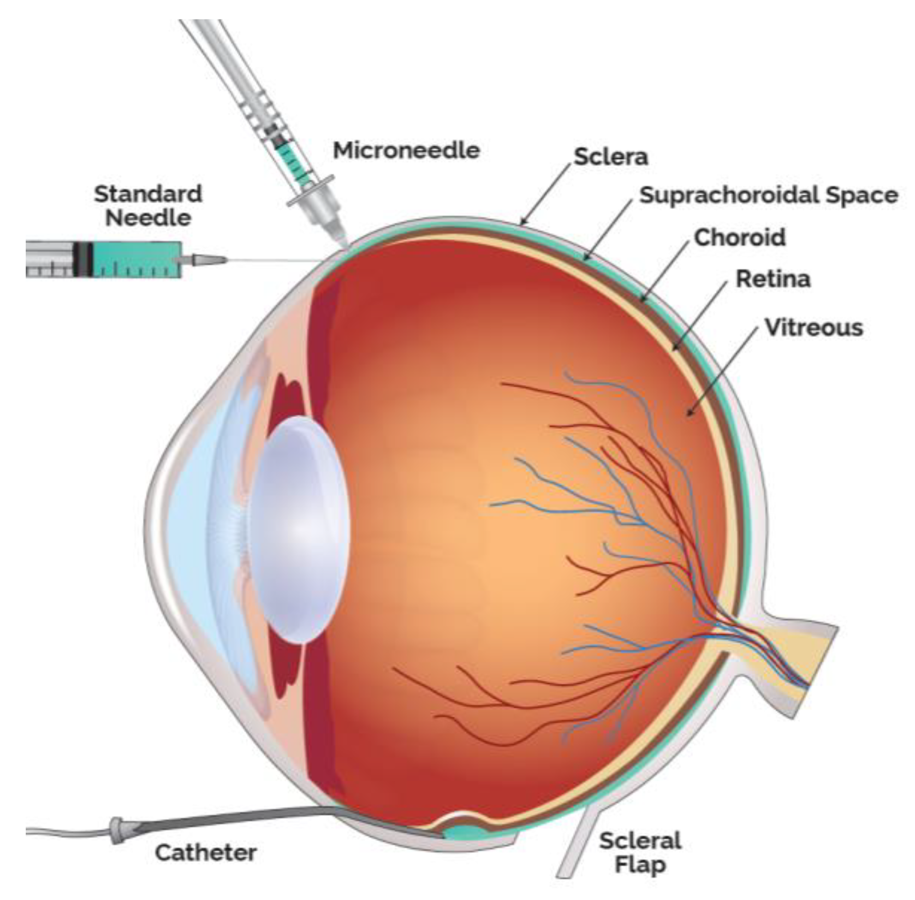 Pharmaceutics | Free Full-Text | Suprachoroidal Delivery of Small  Molecules, Nanoparticles, Gene and Cell Therapies for Ocular Diseases | HTML