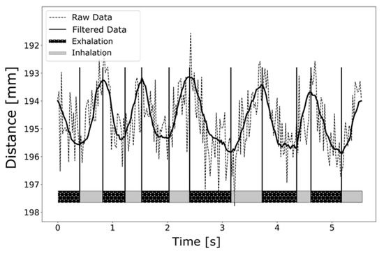Spontaneous Breathing Patterns of Very Preterm Infants Treated With  Continuous Positive Airway Pressure at Birth