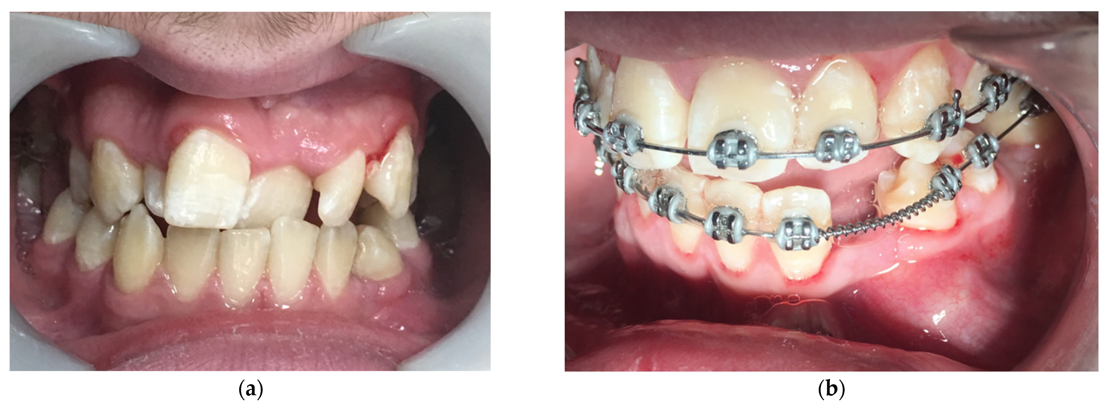 Diode Laser Gum Contouring After Braces