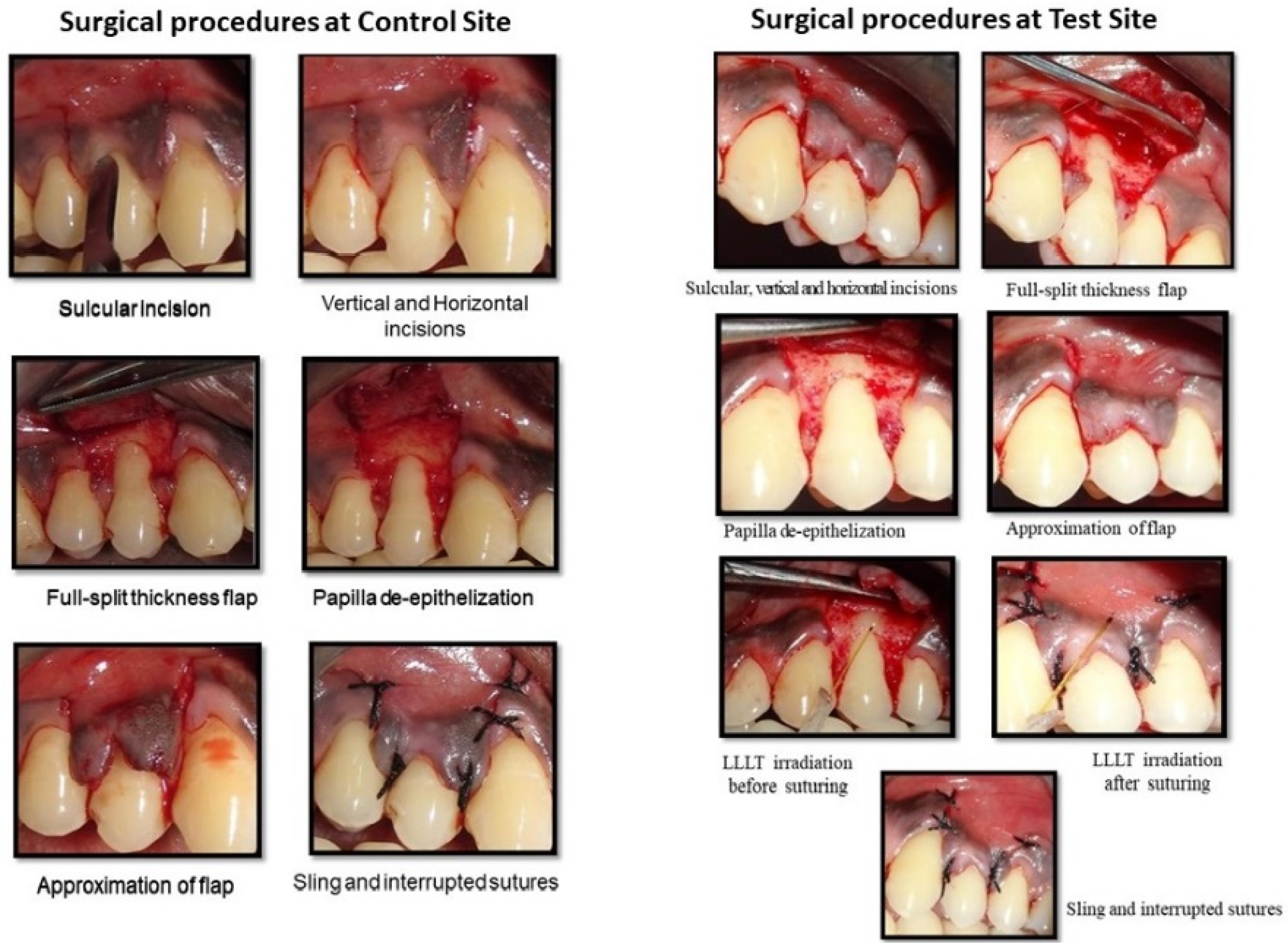 Photonics | Free Full-Text | Clinical Assessment of the Effects of  Low-Level Laser Therapy on Coronally Advanced Flap Procedure in the  Management of Isolated Gingival Recession