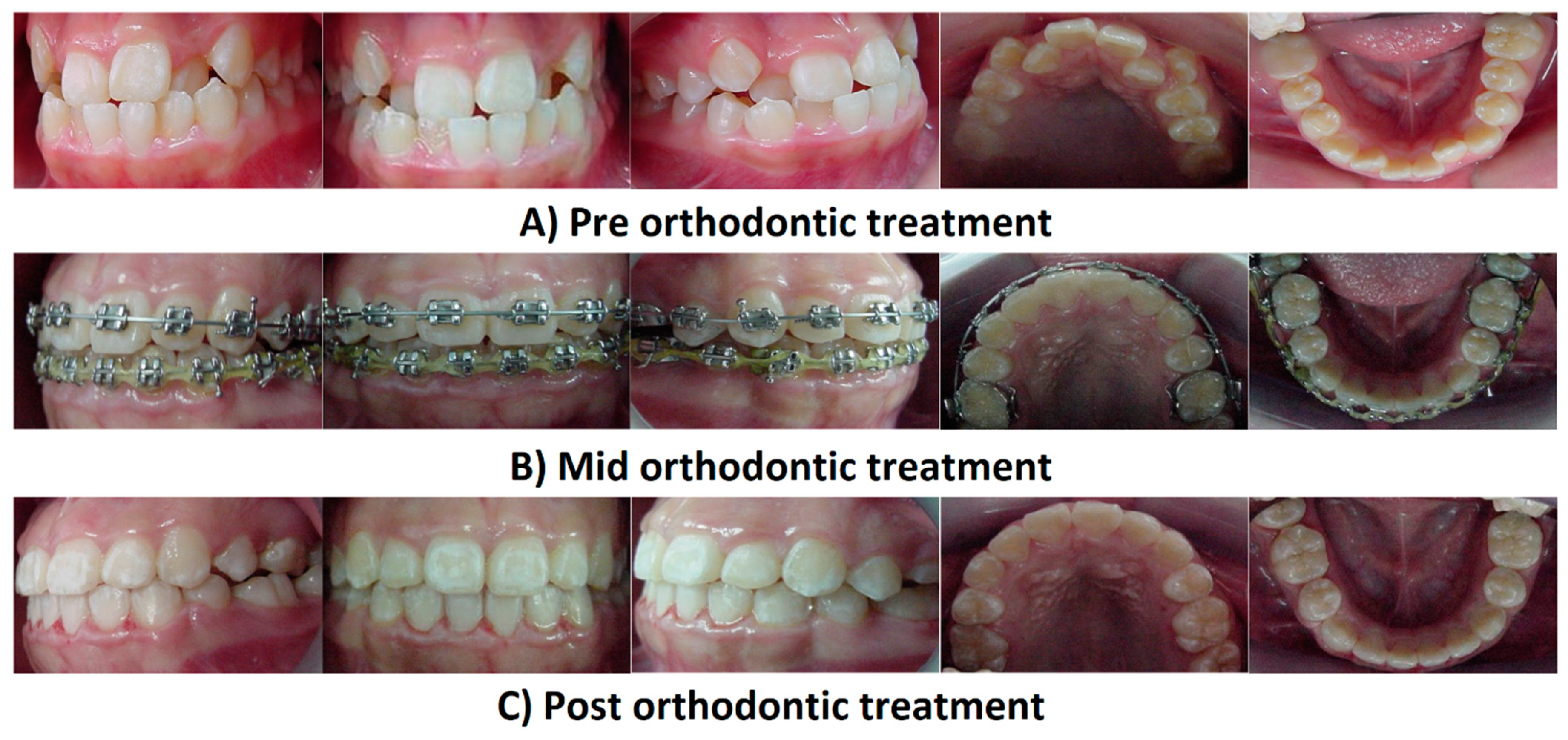 Thermal Wires  Orthodontics in London