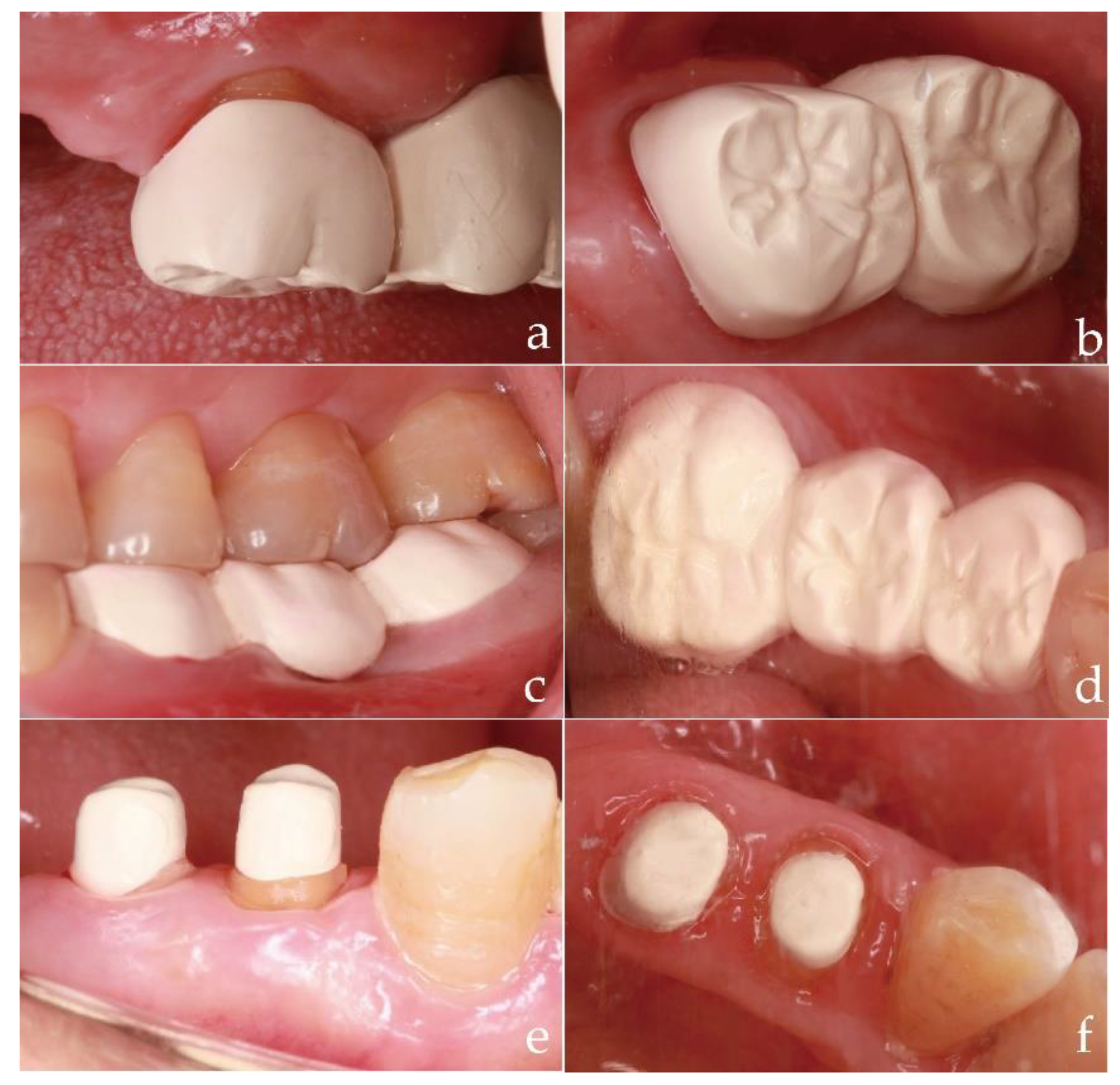 Polymers | Free Full-Text | PEEK in Fixed Dental Prostheses: Application  and Adhesion Improvement
