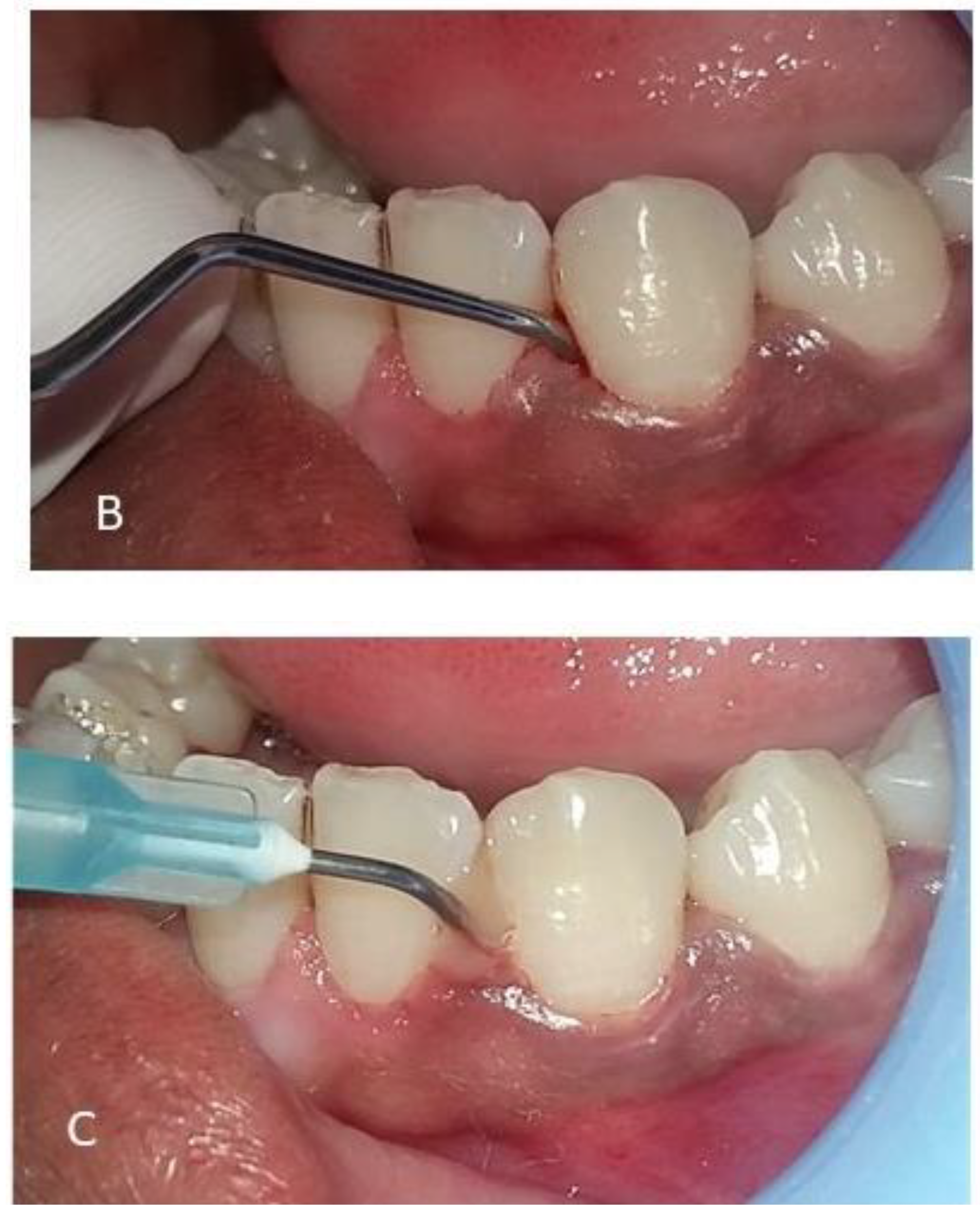 Cureus, Comparative Clinical Study Between Chlorhexidine Gel (0.2%) and  Hyaluronic Gel (1%) in the Prevention of a Dry Socket After Tooth  Extraction for Orthodontic Treatment