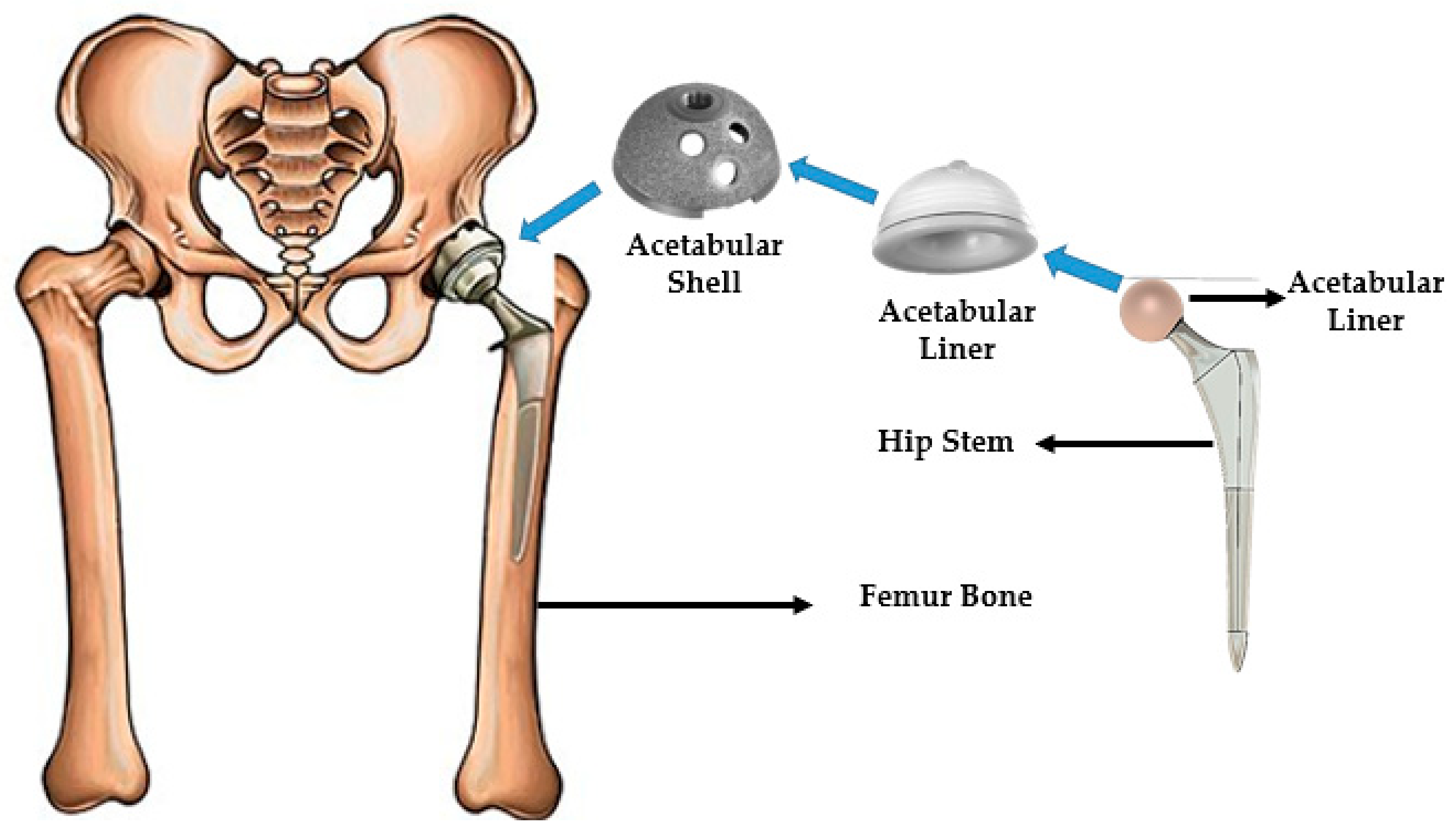 Polymers | Free Full-Text | A Review of Biomaterials and Associated  Performance Metrics Analysis in Pre-Clinical Finite Element Model and in  Implementation Stages for Total Hip Implant System