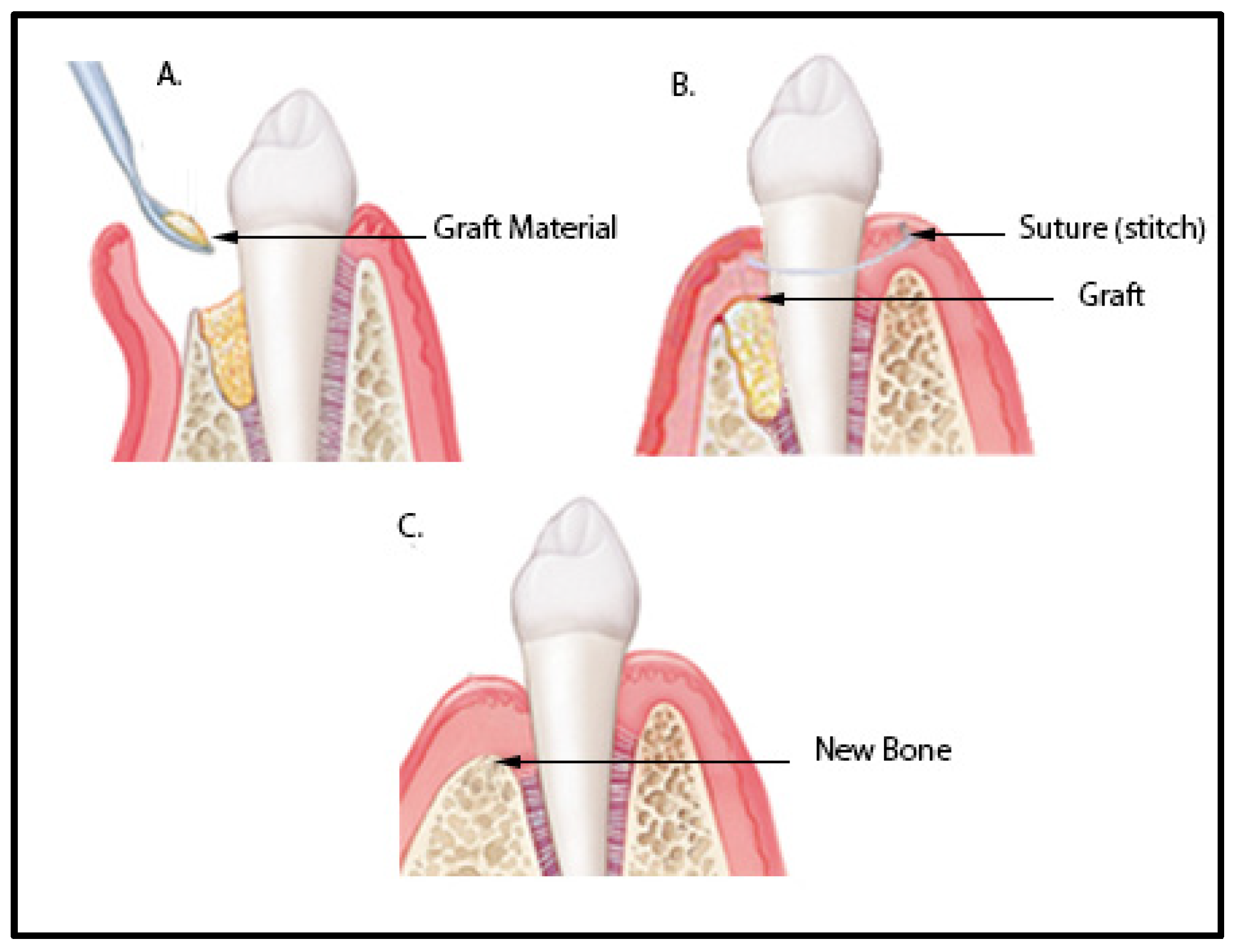 ODONTOLOGIC SUTURE KIT   dental deposit