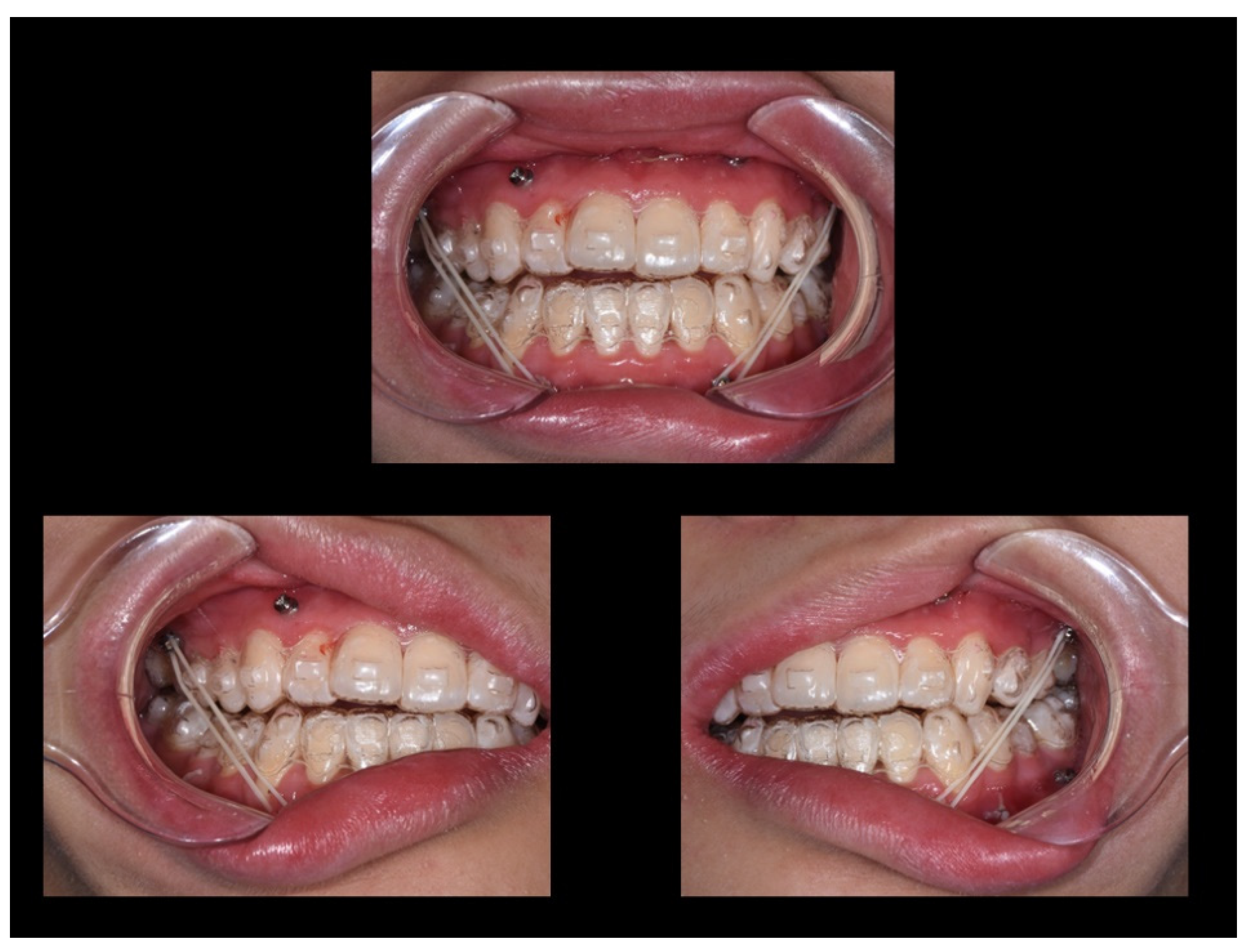 Surgical Orthodontics - Advanced Orthodontics