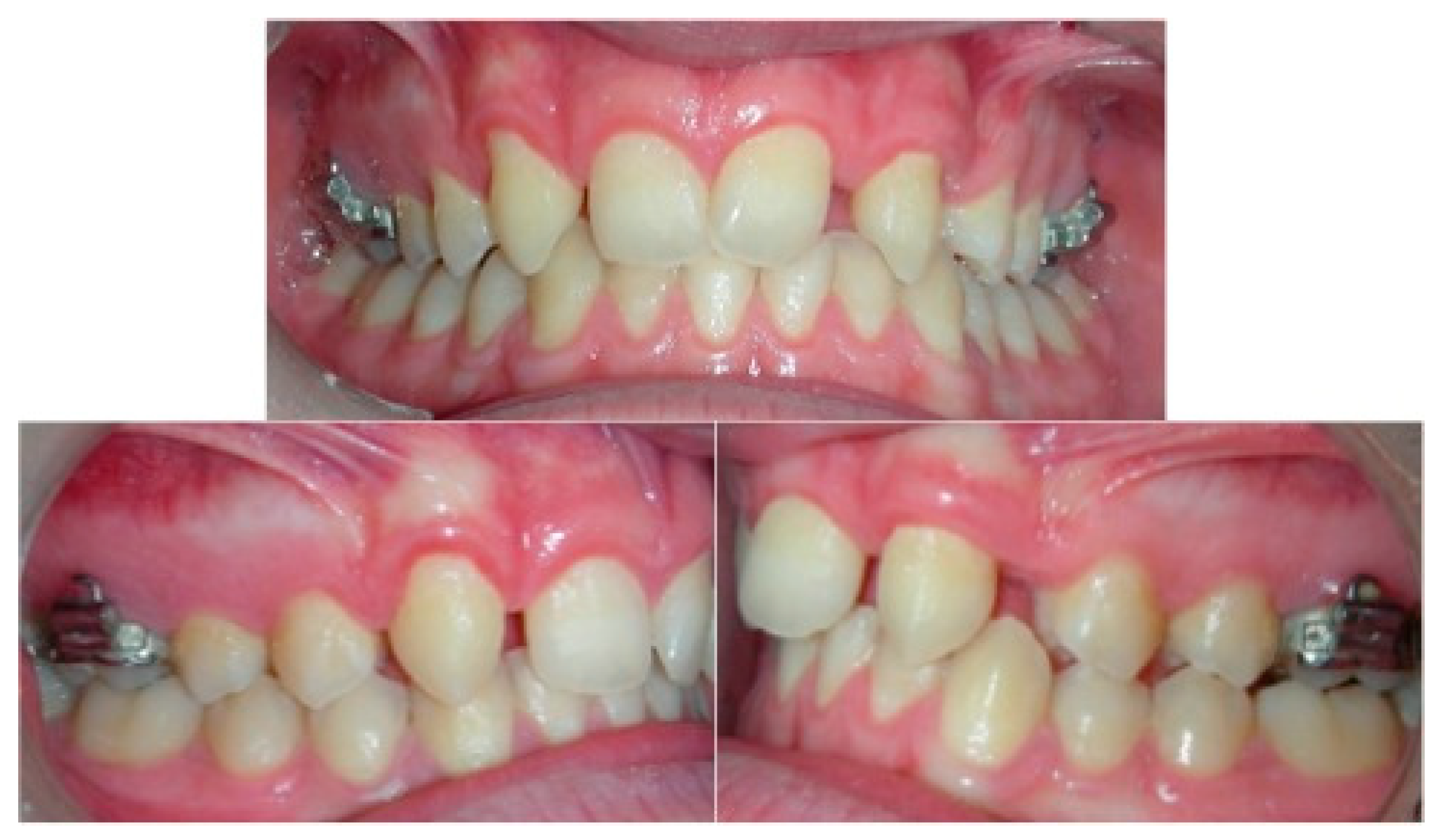 Prosthesis Free Full Text An Integrated Approach Orthodontic And Prosthetic In A Case Of Maxillary Lateral Incisors Agenesis Html