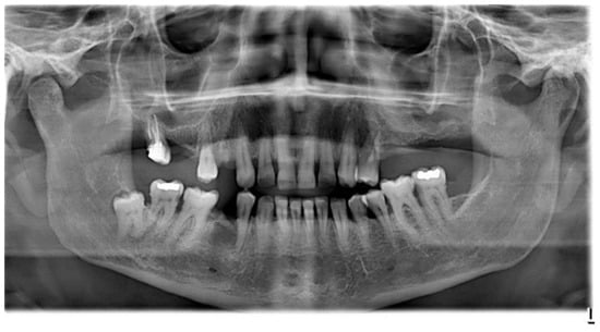 Prosthesis | Free Full-Text | Construction of a Removable Partial ...