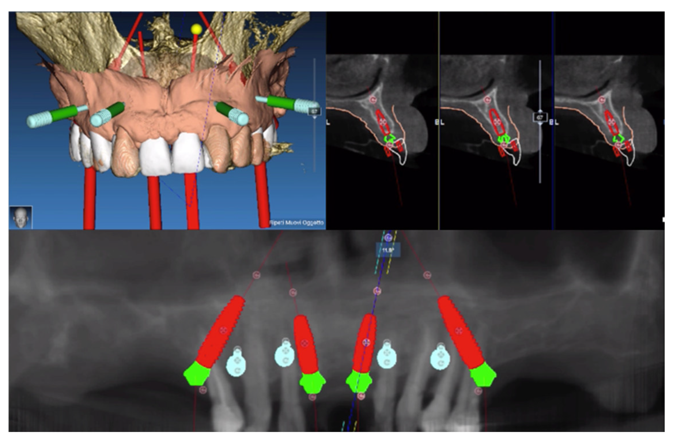 Prosthesis, Free Full-Text