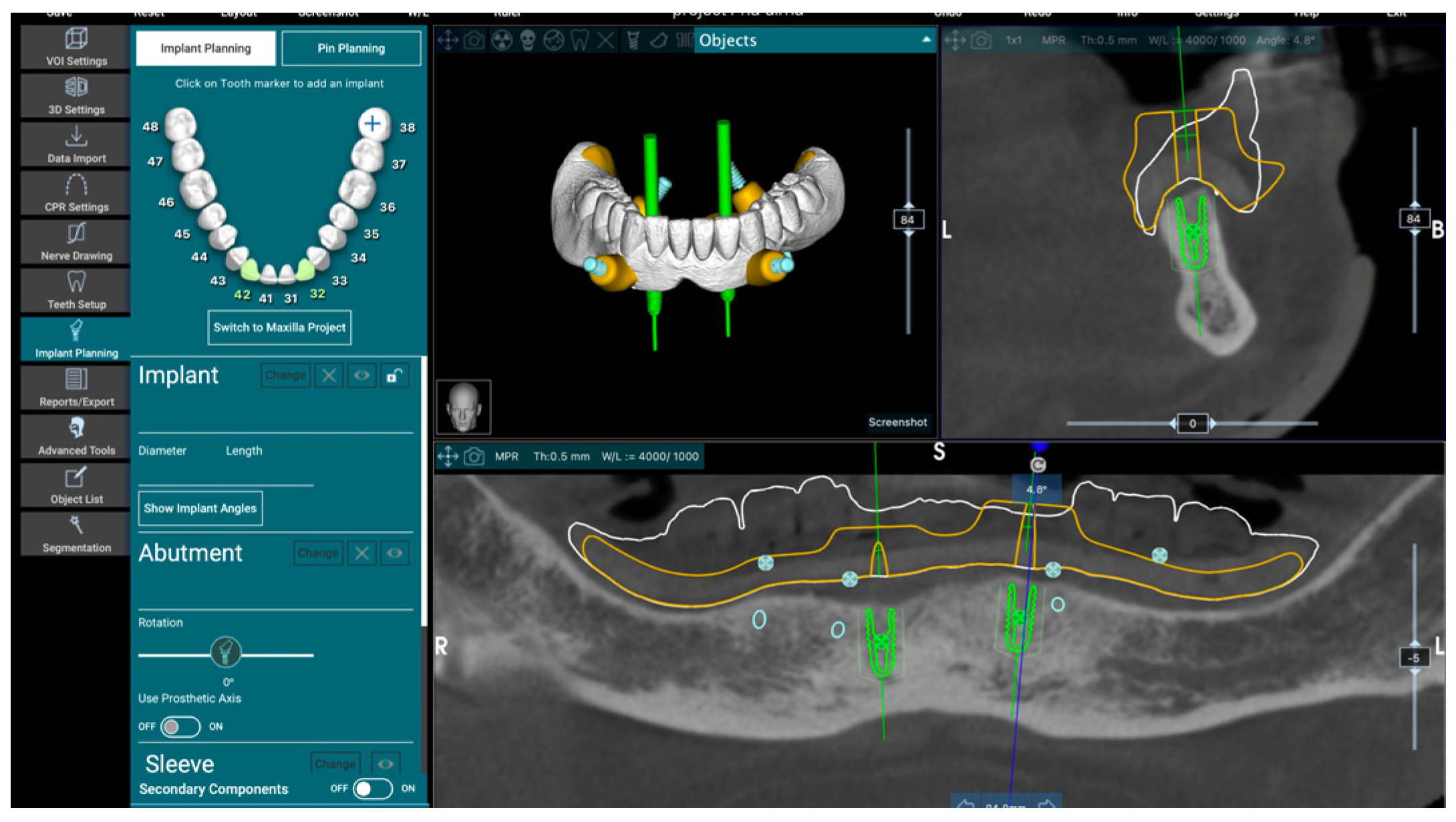 Prosthesis | Free Full-Text | Digital Workflow For Prosthetically ...