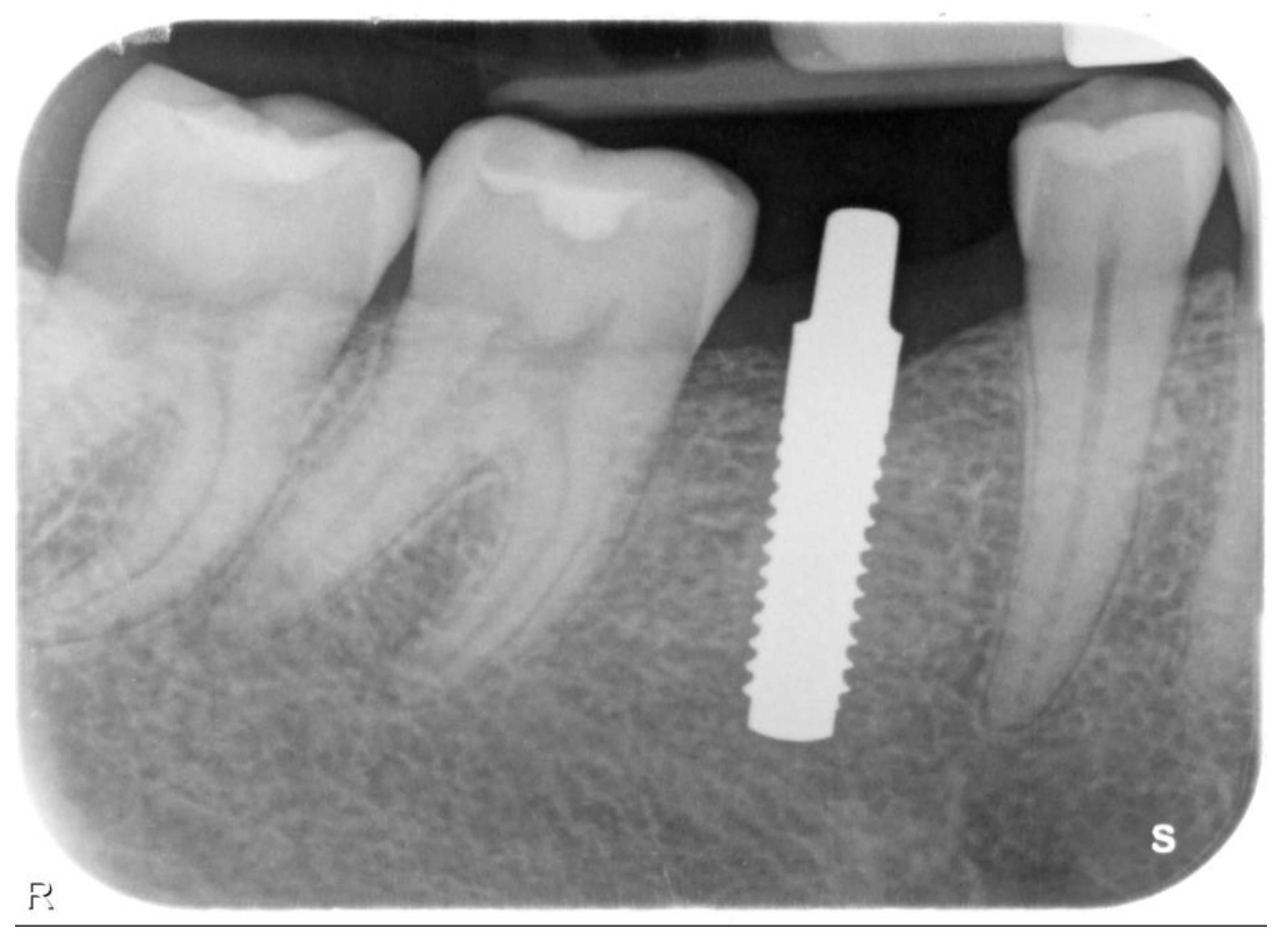 Prosthesis | Free Full-Text | Single Crown Restorations Supported