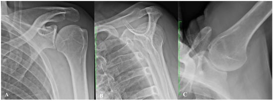 Upper Arm (Humeral Shaft) Fractures - Dr. Groh