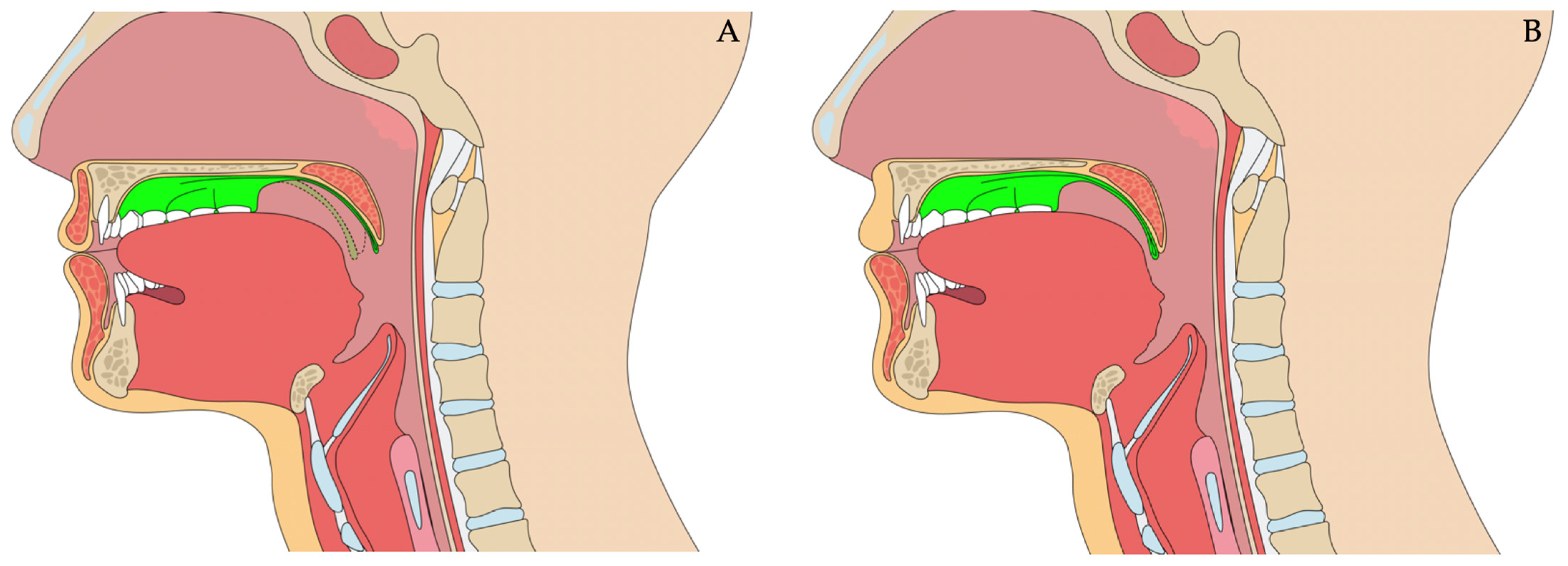 Prosthesis 