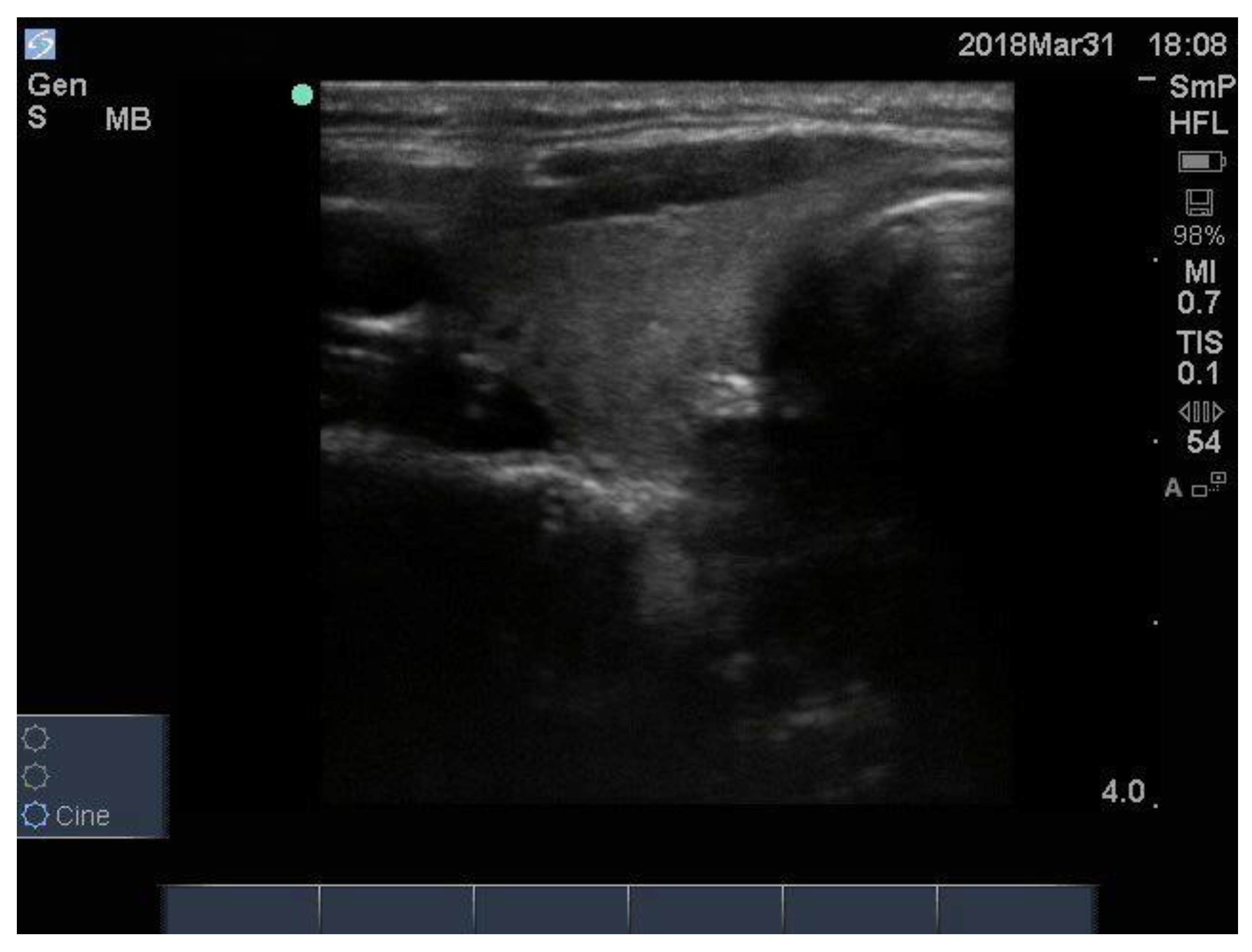 papillary thyroid cancer ultrasound