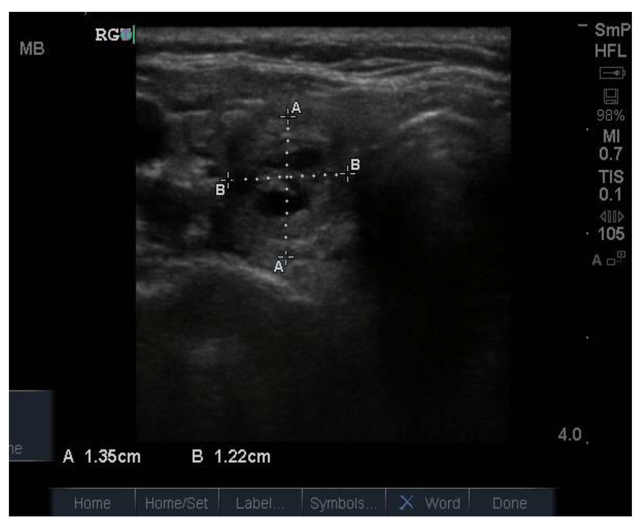 thyroid cyst ultrasound