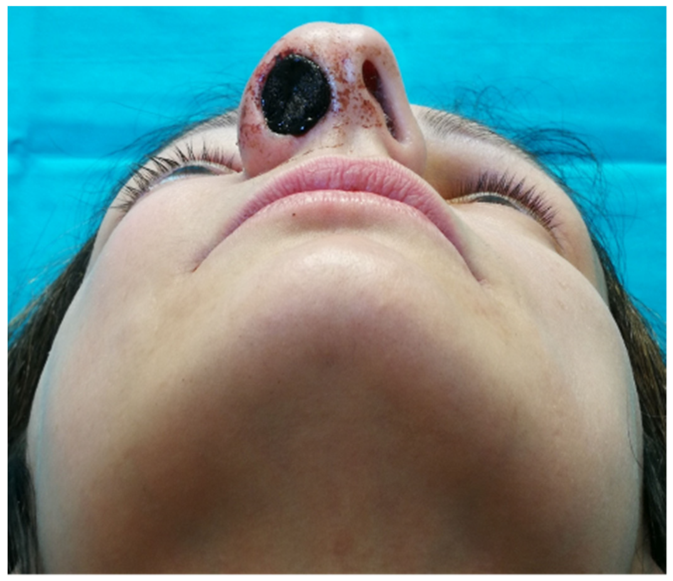 Nasal polyps online lump inside nose