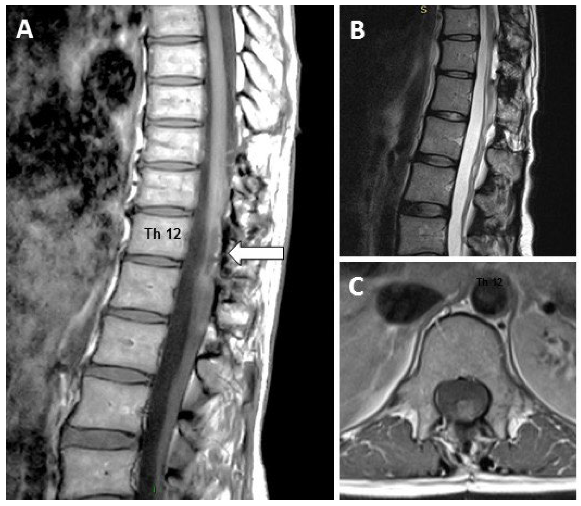 Reports | Free Full-Text | Intrathecal Cell Therapy with Autologous Bone  Marrow Stromal Cells as a New Tool for Neurologic Sequels after Spinal Cord  Surgery: A Report of Two Cases