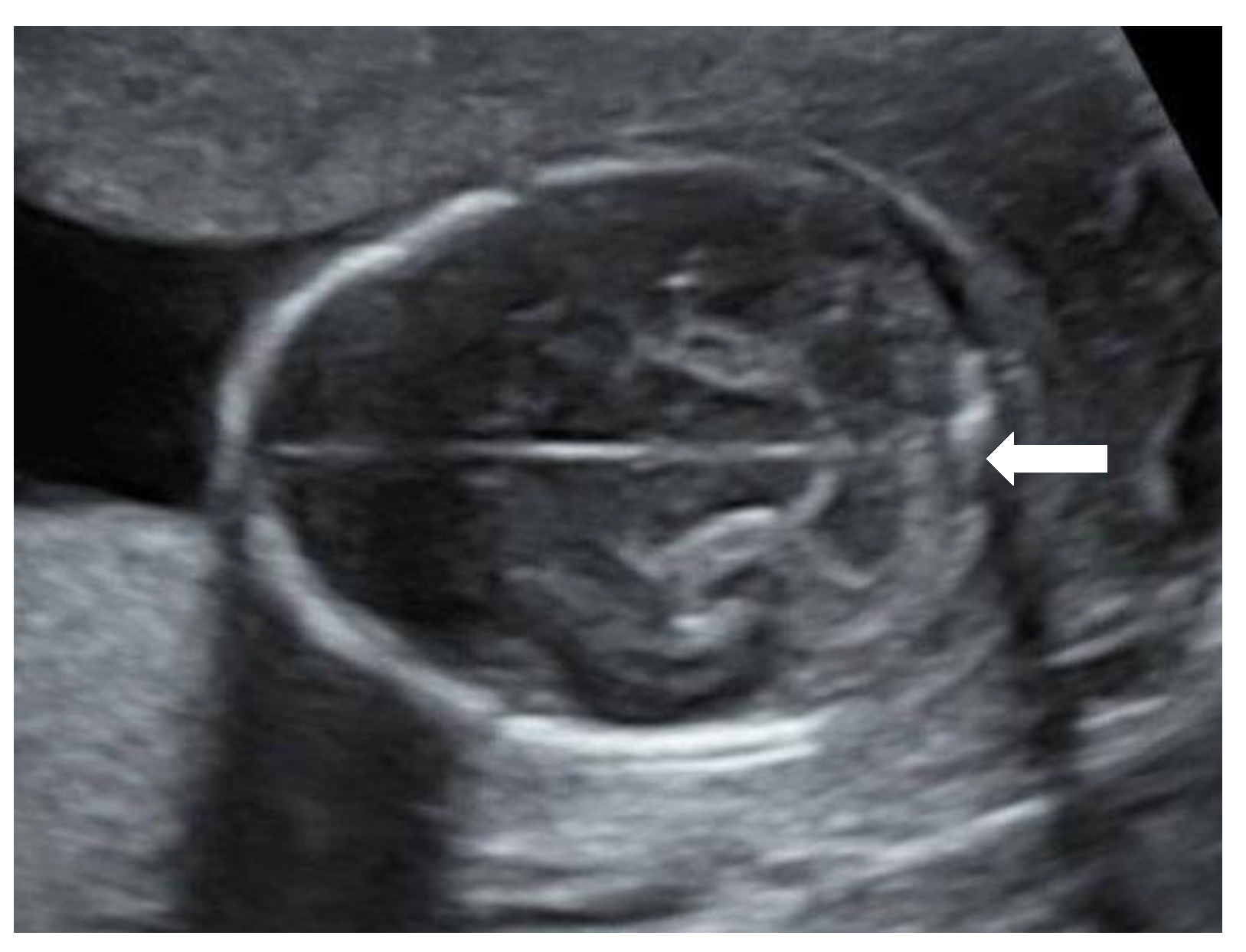 anencephaly ultrasound findings