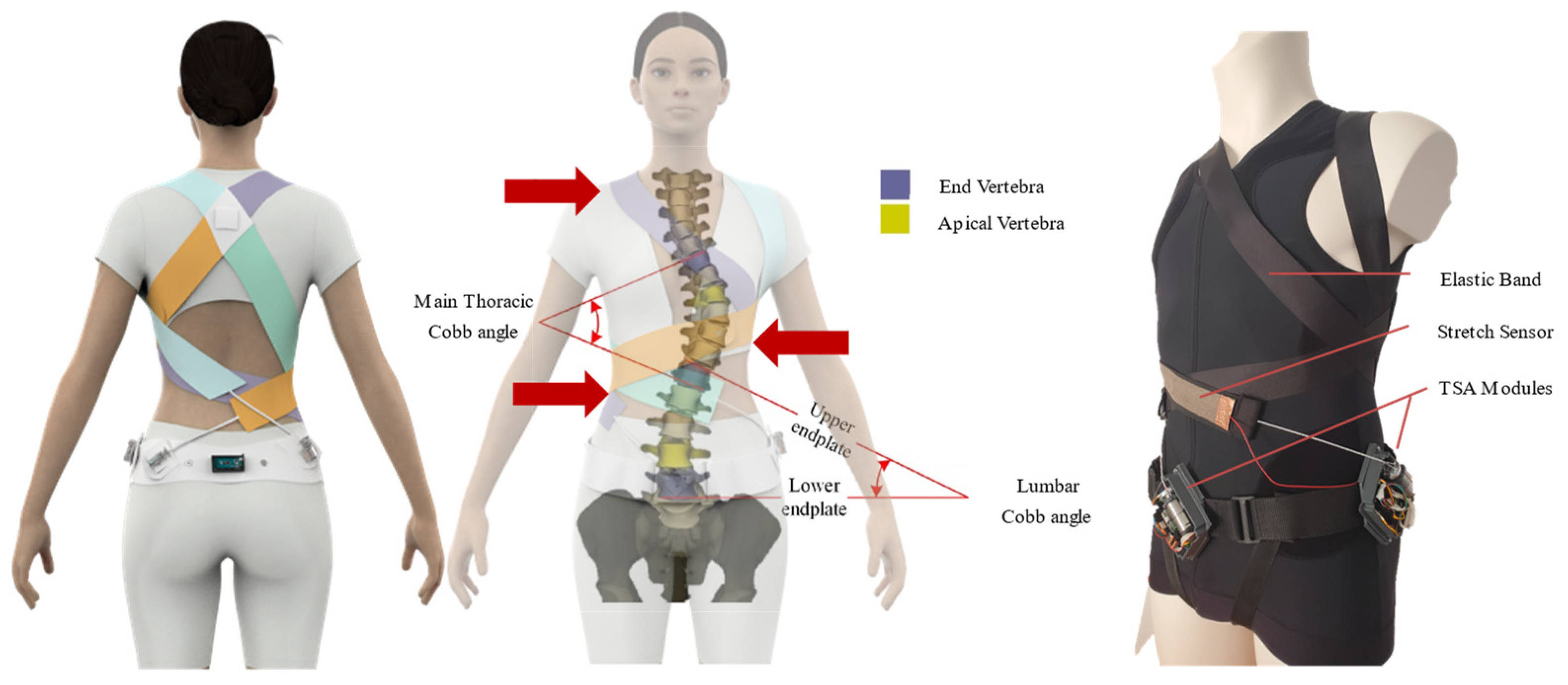 Scoliosis Braces: Can Scoliosis be Corrected with a Brace