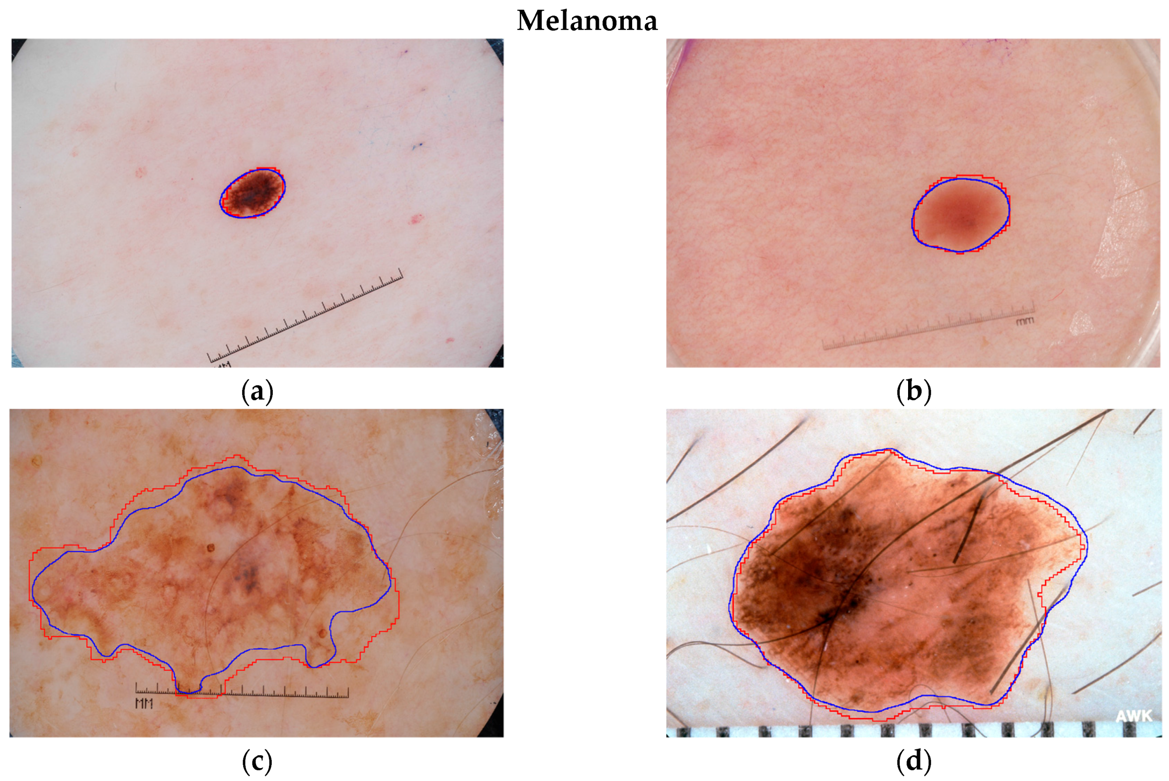 Sensors Free Full Text Skin Lesion Analysis Towards Melanoma Detection Using Deep Learning