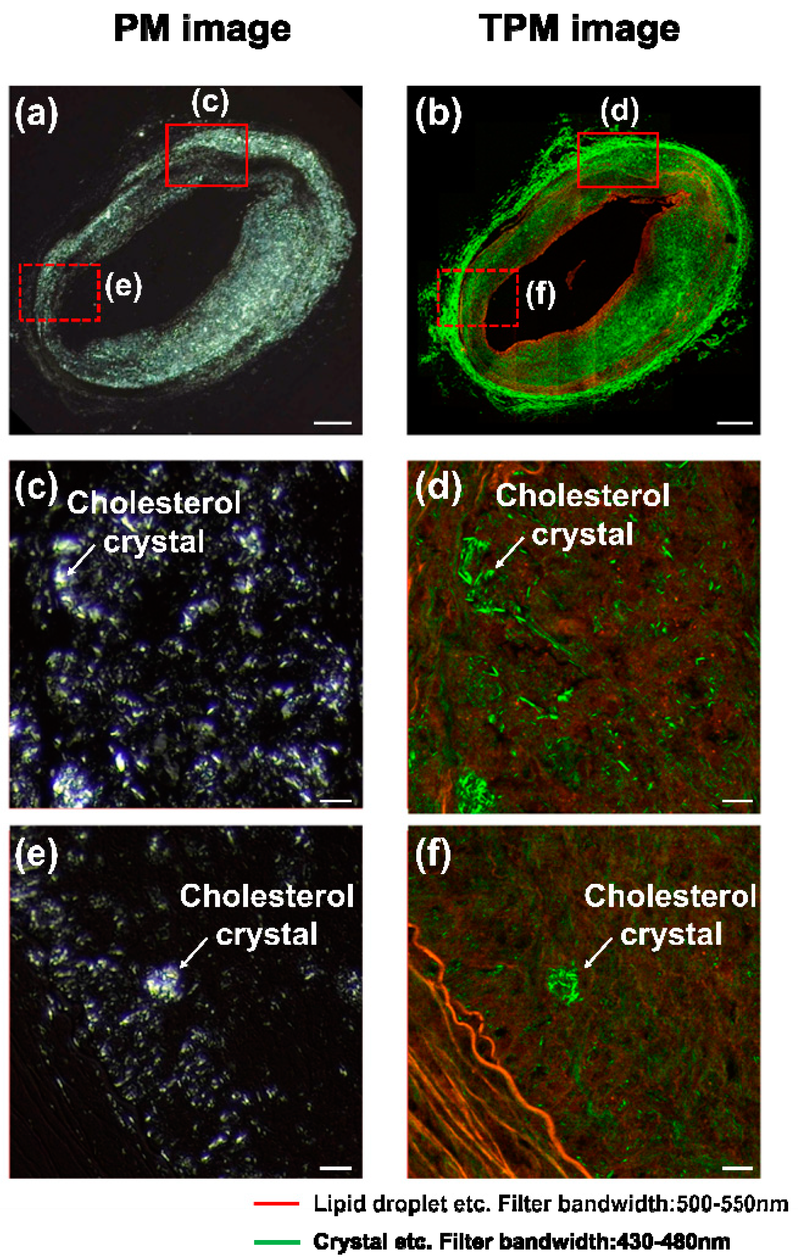 cholesterol crystals