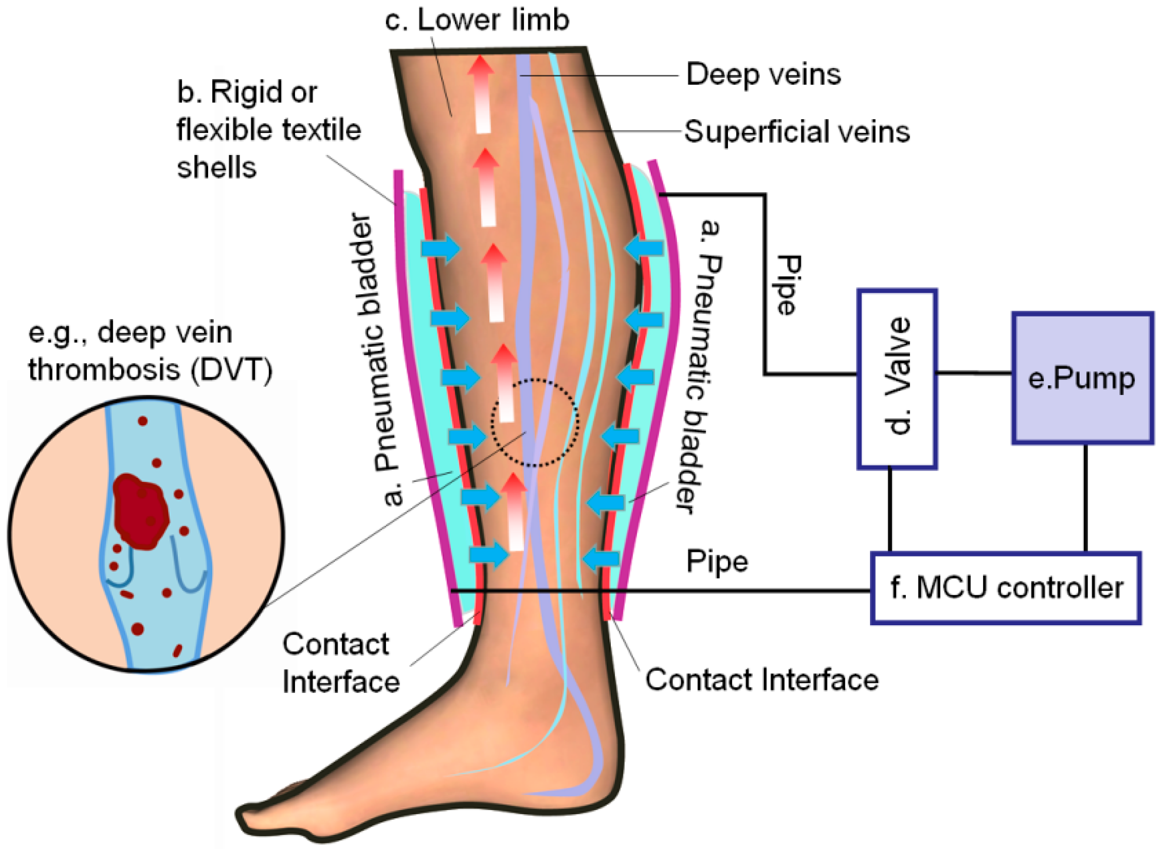Sensors | Free Full-Text | Dynamic Interface Pressure Monitoring System for  the Morphological Pressure Mapping of Intermittent Pneumatic Compression  Therapy