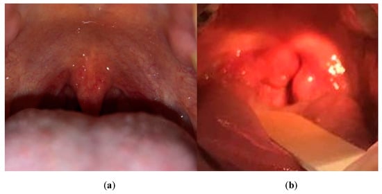 Sensors | Free Full-Text | Novel Image Processing Method for Detecting Strep  Throat (Streptococcal Pharyngitis) Using Smartphone | HTML