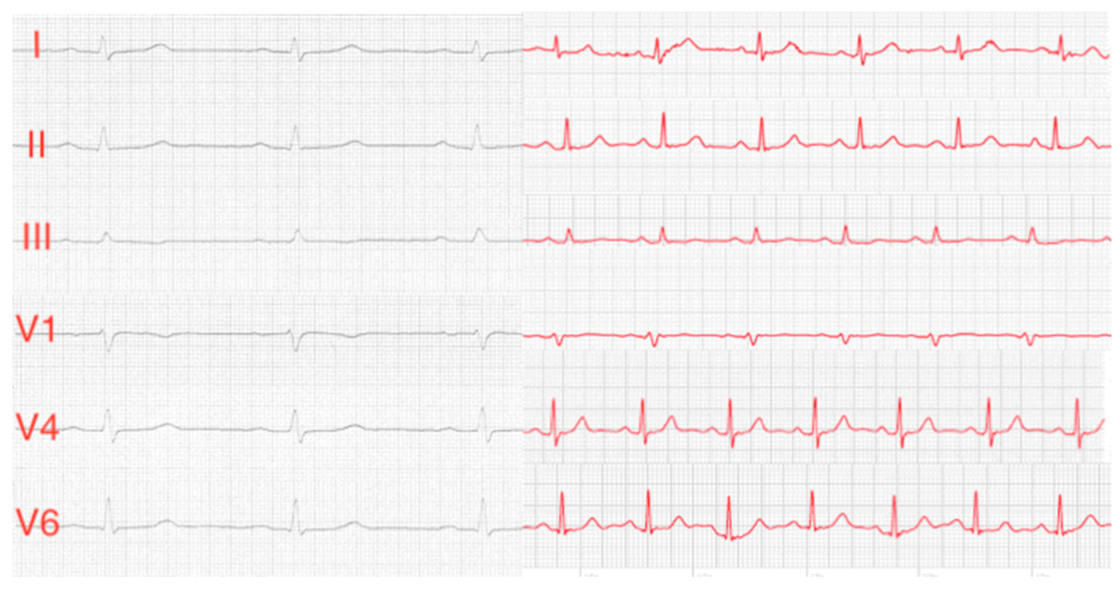 Часы с экг. Single lead ECG. Single‐lead ECG Patch device. Single lead ECG identification. Children ECG leads v4.