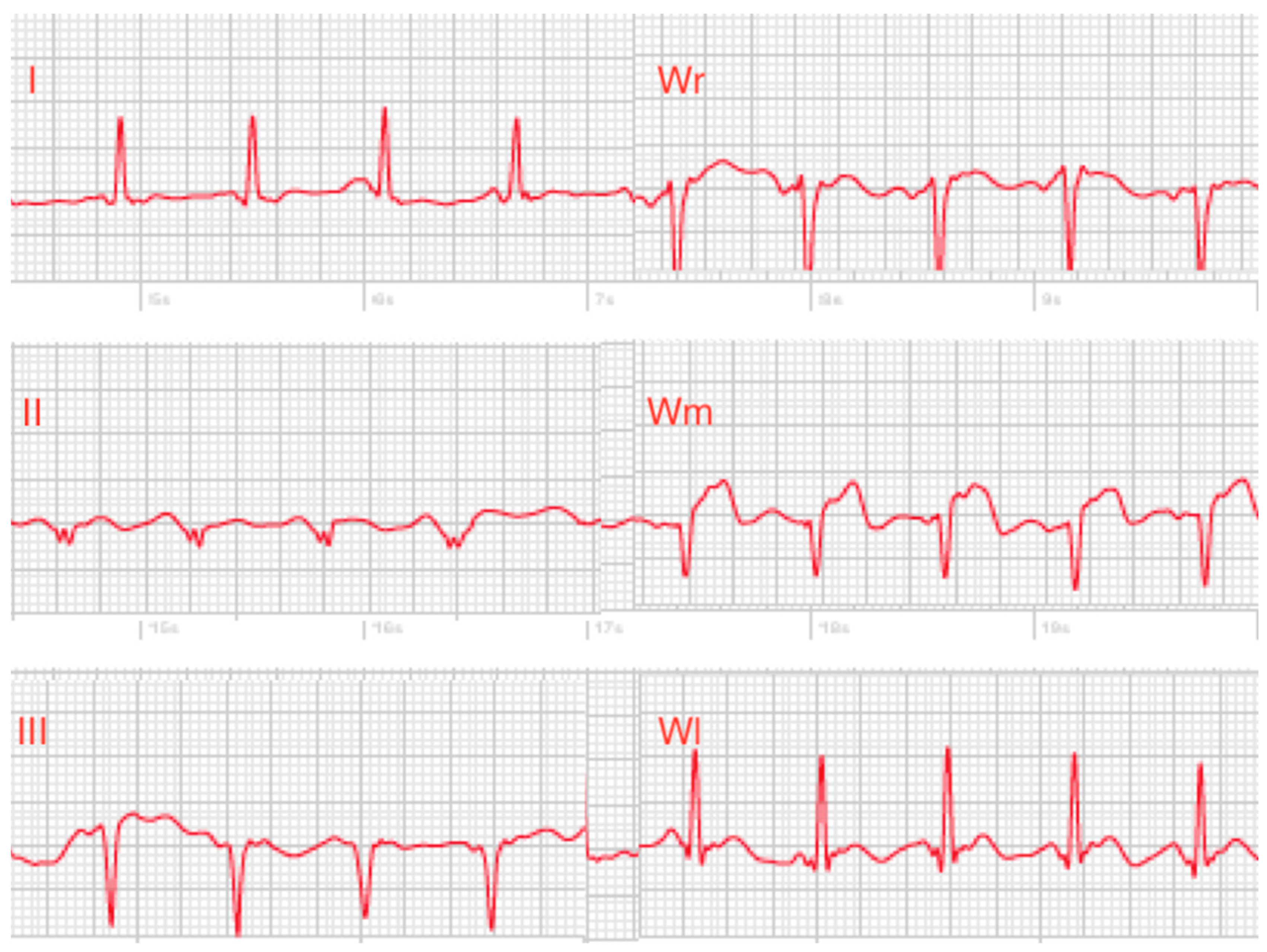 ECG Recordings Including Einthoven and Wilson Leads by a Smartwatch: A New ...