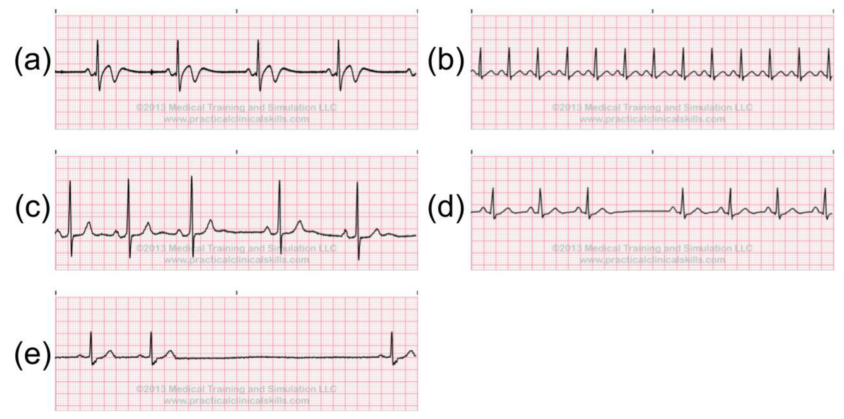 Early CVD Detection with BPM & ECG