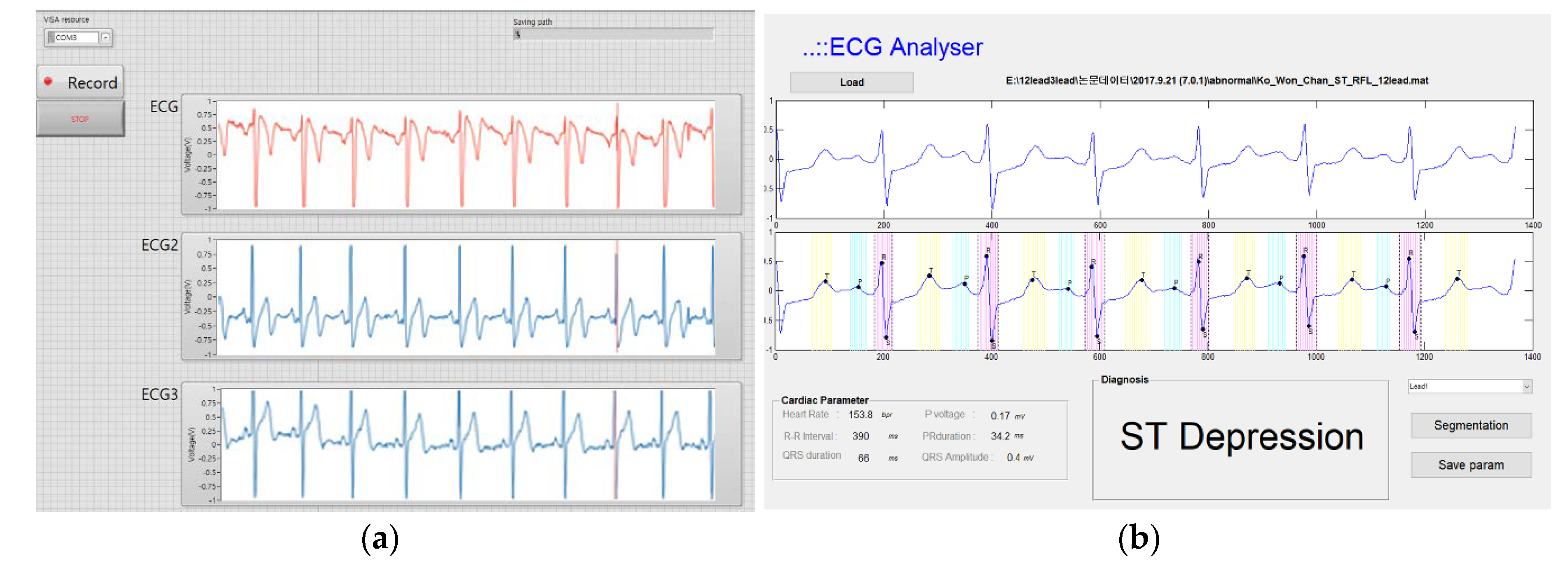 Sensors Free Full Text Reconstruction Of 12 Lead Electrocardiogram From A Three Lead Patch Type Device Using A Lstm Network Html