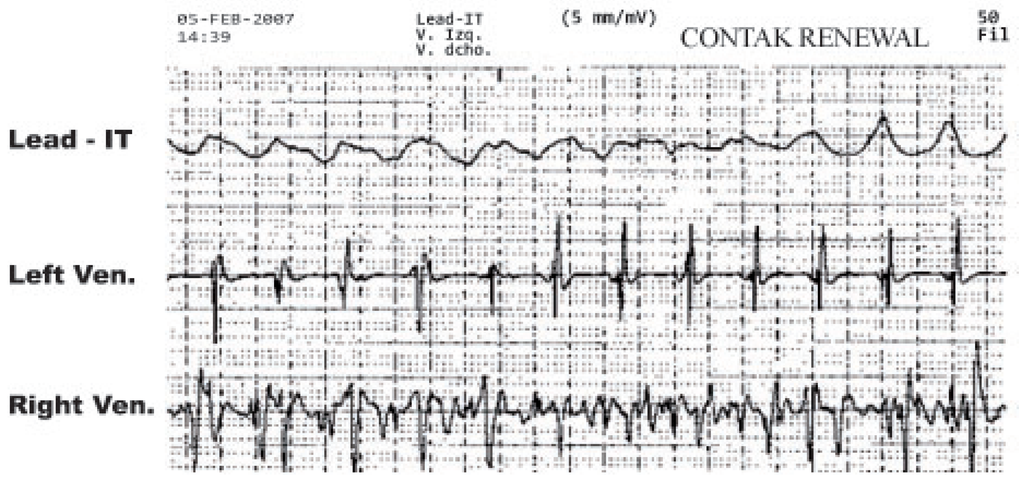 Typical recordings of mean arterial pressure and mean EGM amplitude in