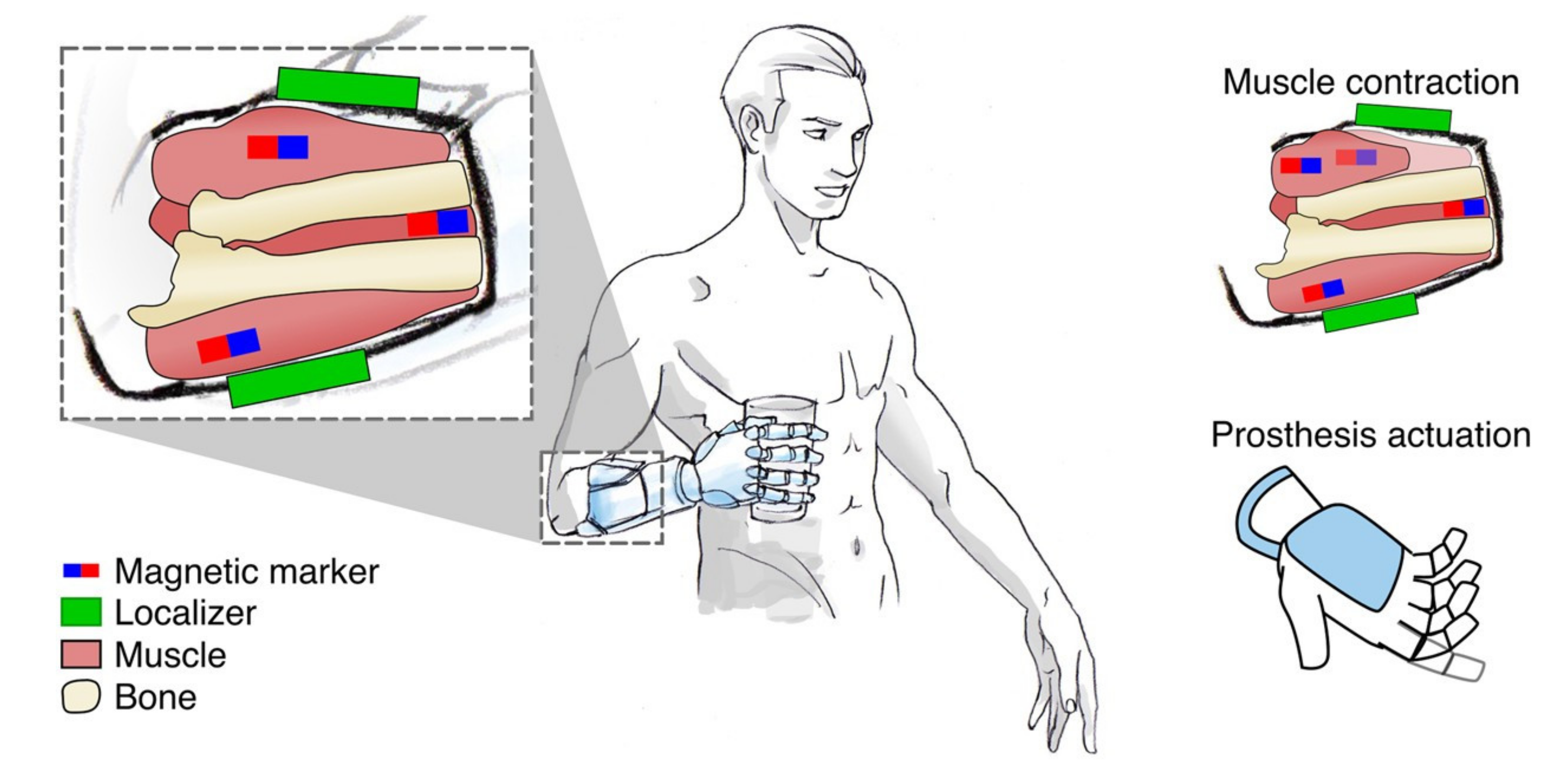 Electrodes in remaining arms give amputees better control of