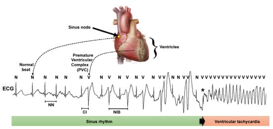 Sensors | Free Full-Text | Prediction of Sudden Cardiac Death Risk with ...