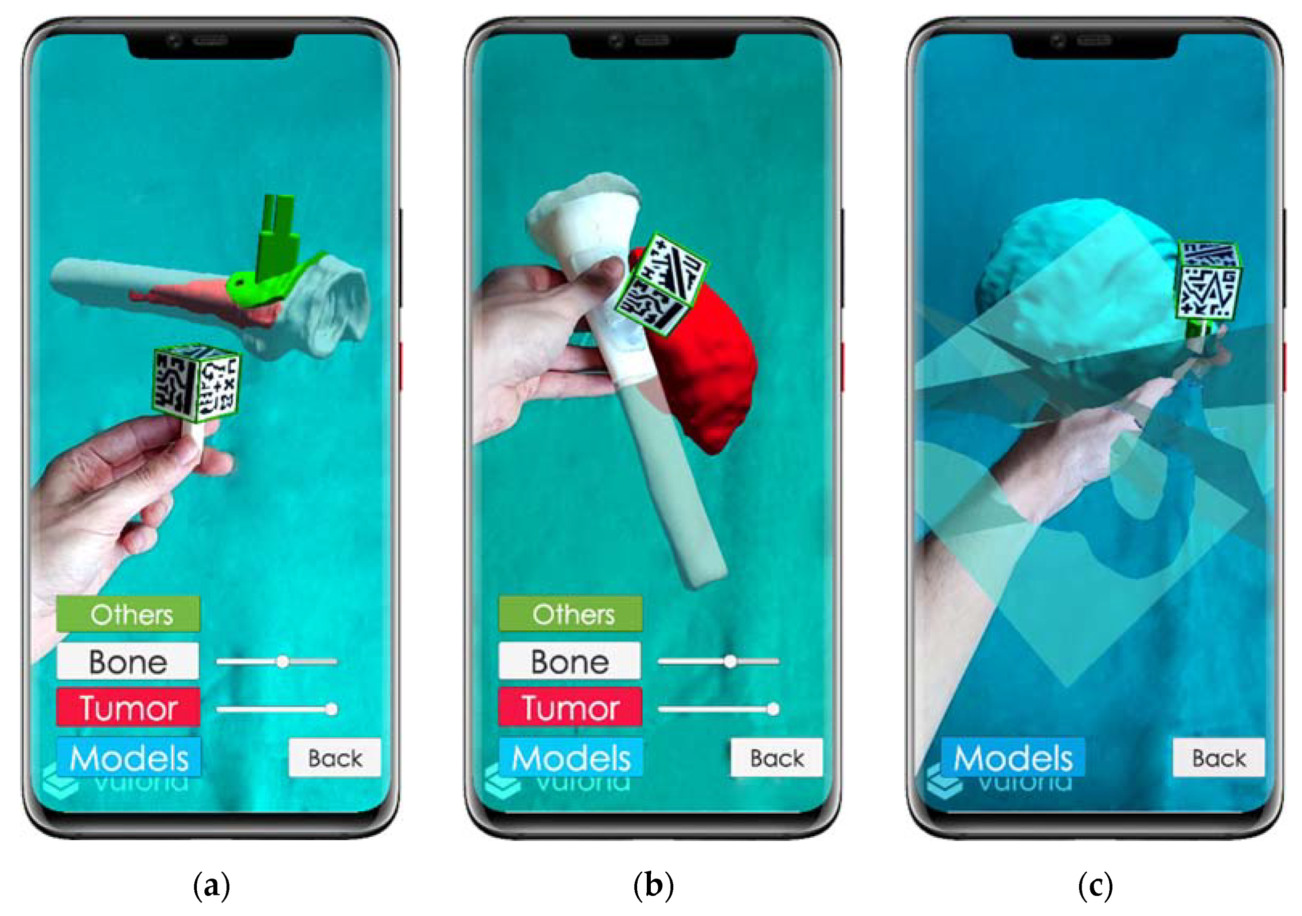 Sensors Free Full Text Combining Augmented Reality And 3d Printing To Improve Surgical Workflows In Orthopedic Oncology Smartphone Application And Clinical Evaluation Html