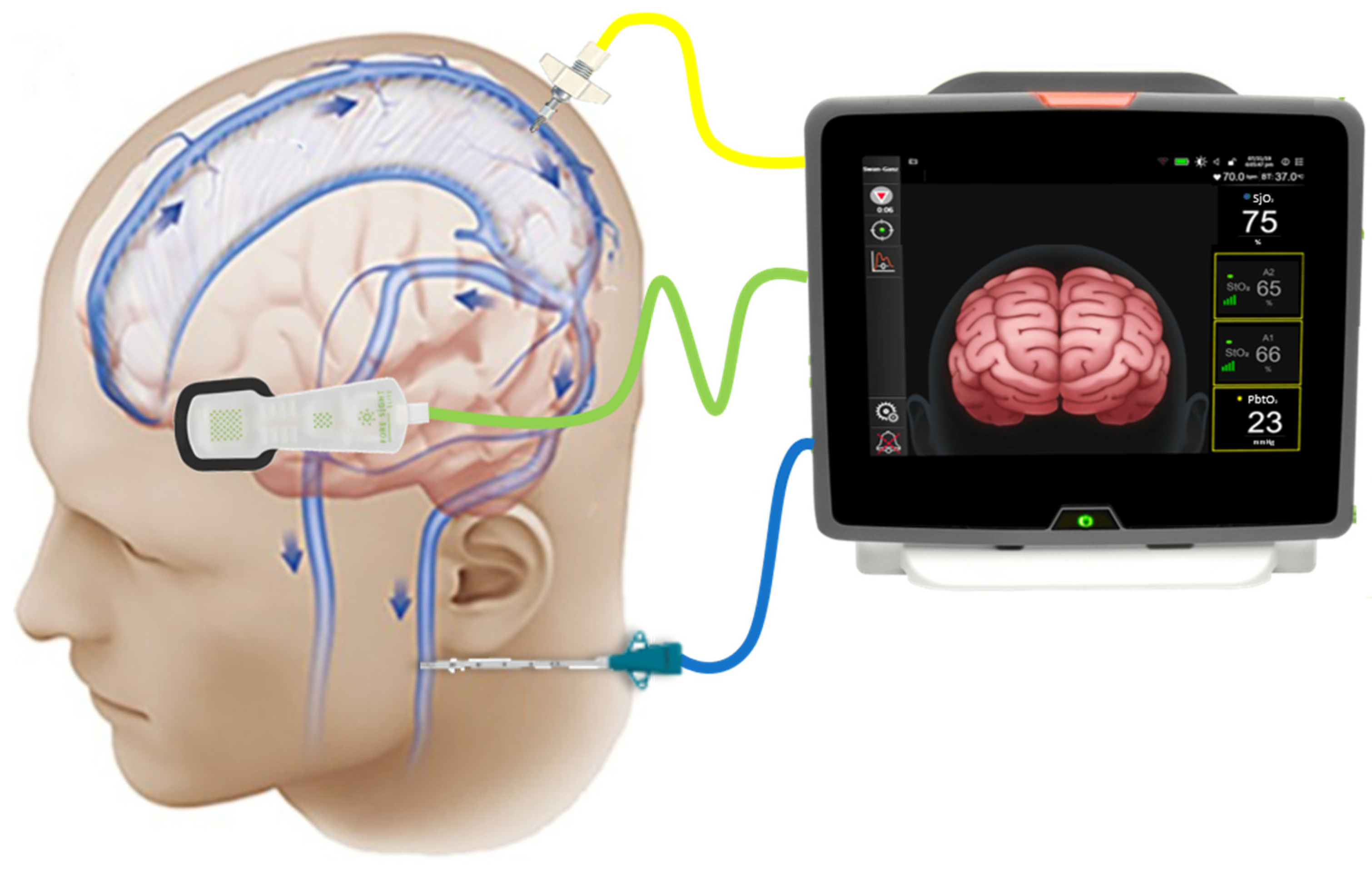 Sensors | Free Full-Text | Near-Infrared Spectroscopy (NIRS) in Traumatic  Brain Injury (TBI)