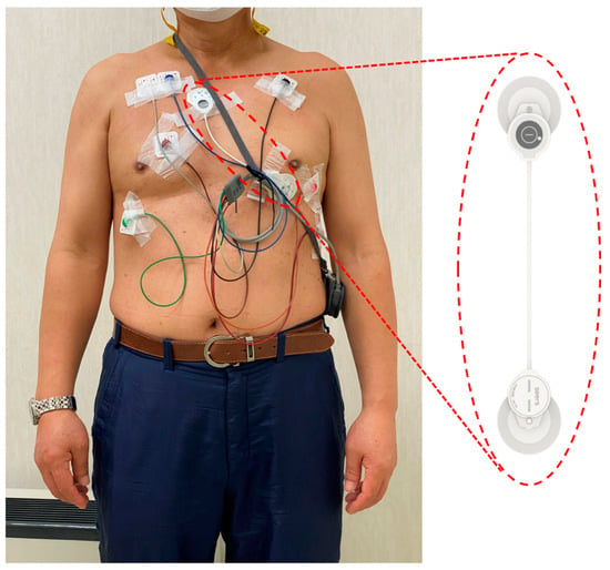 Sensors | Free Full-Text | Validation of Adhesive Single-Lead ECG Device  Compared with Holter Monitoring among Non-Atrial Fibrillation Patients