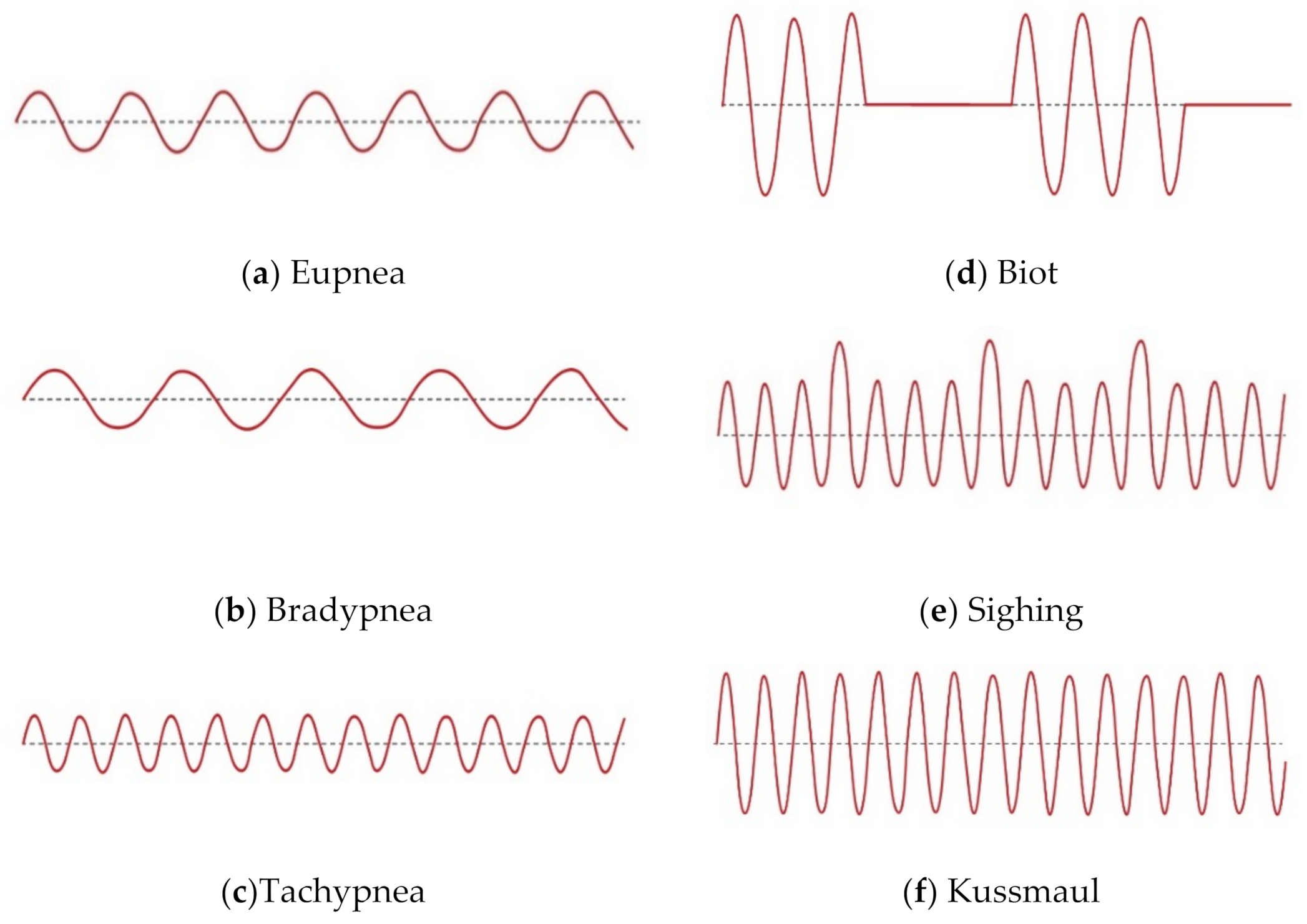 Different breathing patterns wave-forms: (a) apnea; (b) tachypnea; (c)