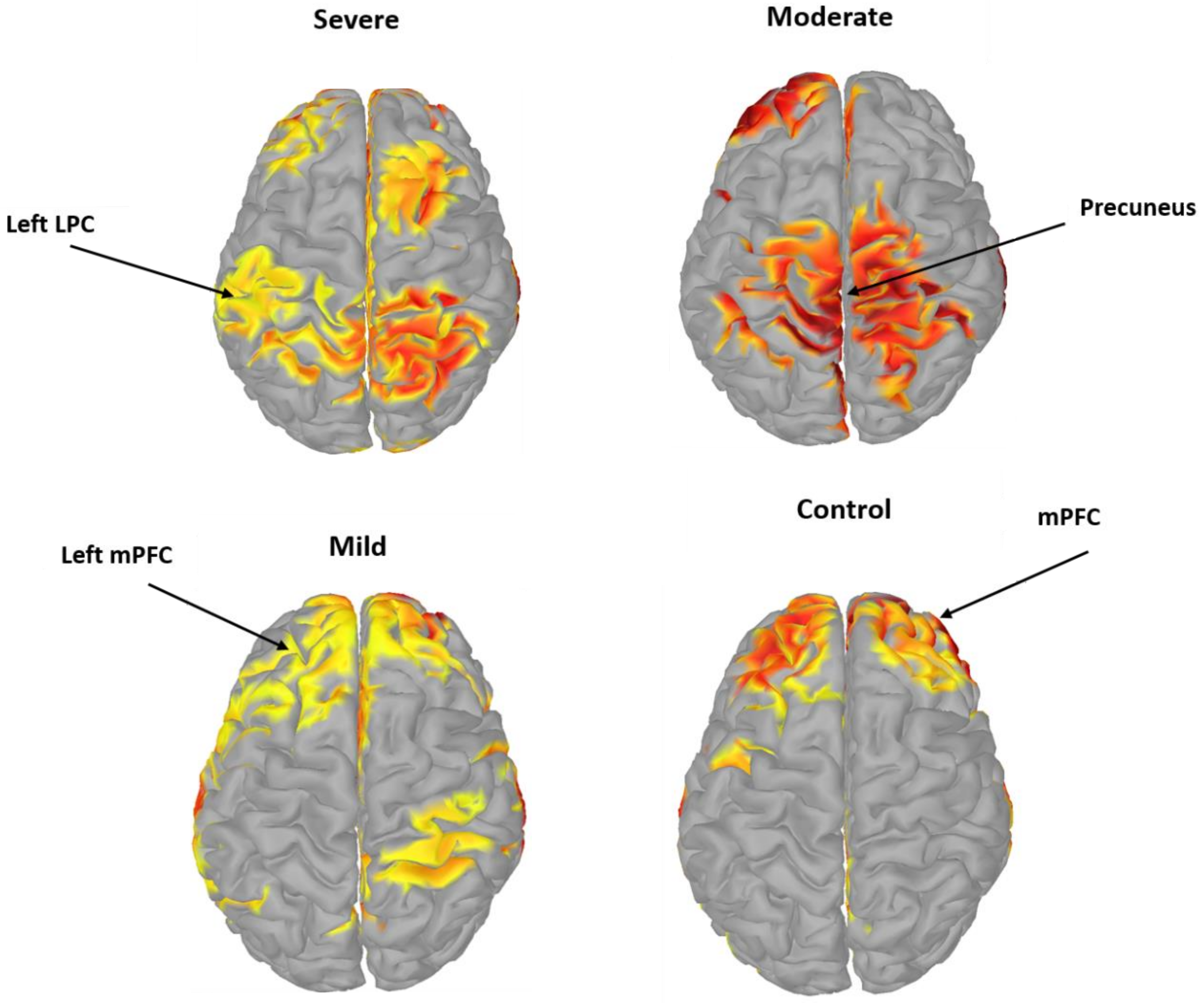 Sensors | Free Full-Text | Analysis of Default Mode Network in Social  Anxiety Disorder: EEG Resting-State Effective Connectivity Study