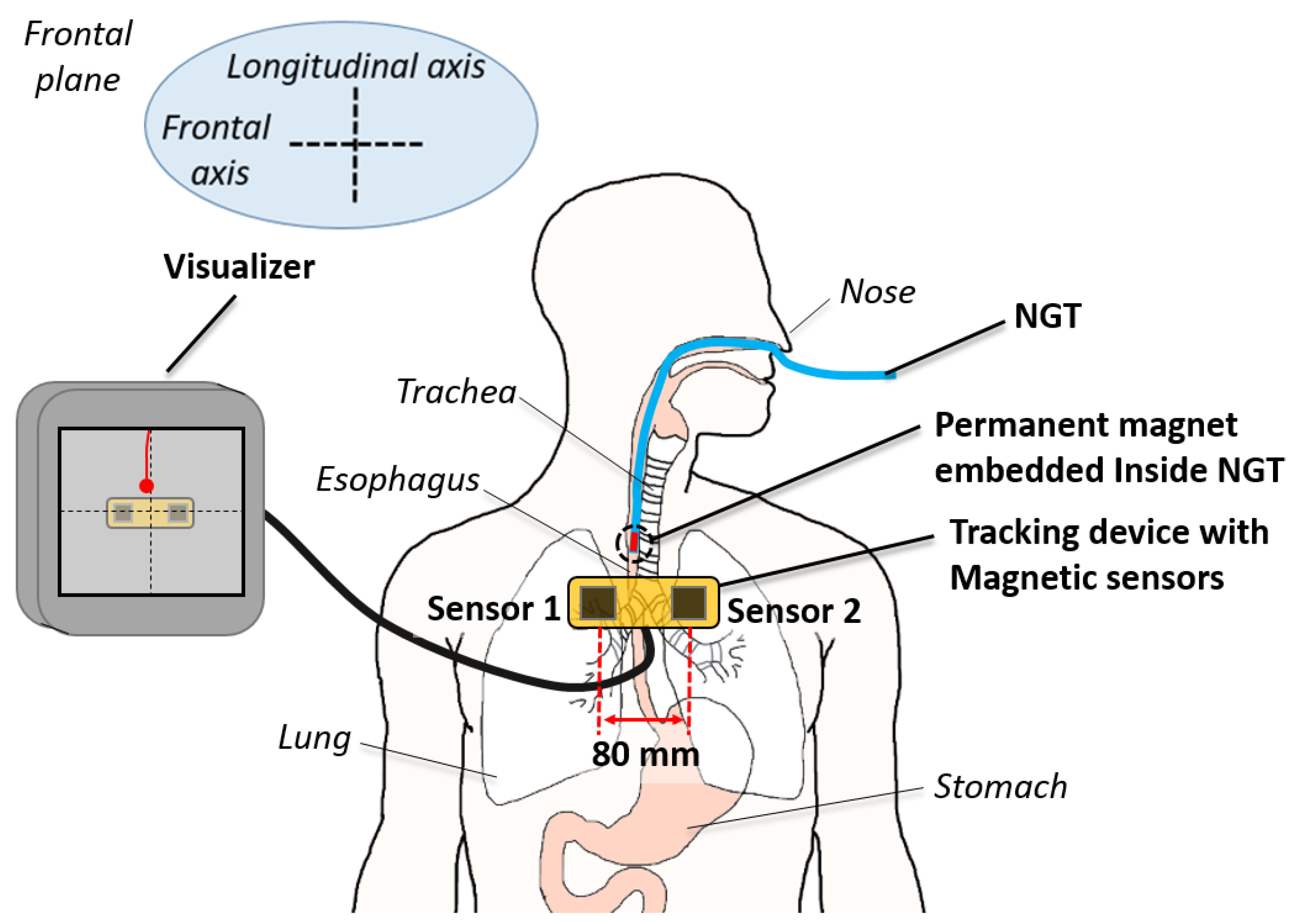 Sensors | Free Full-Text | A Low-Cost, Point-of-Care Test for Confirmation  of Nasogastric Tube Placement via Magnetic Field Tracking