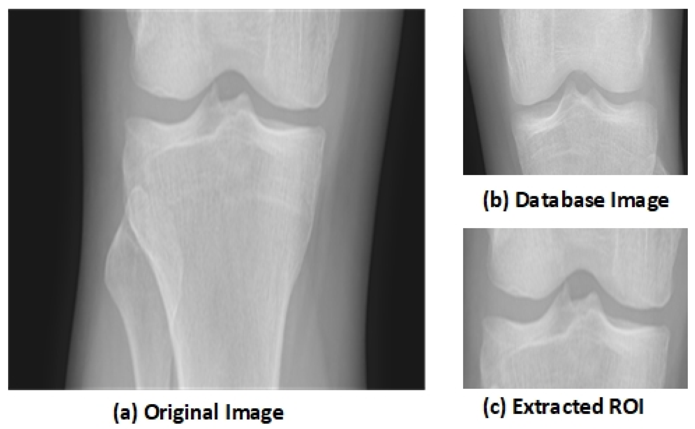 My Fractured Knee Experience - HubPages