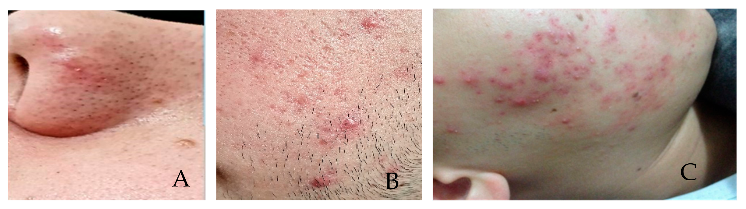 Sensors | Free Full-Text | Effect of Blue Light on Acne Vulgaris: A  Systematic Review