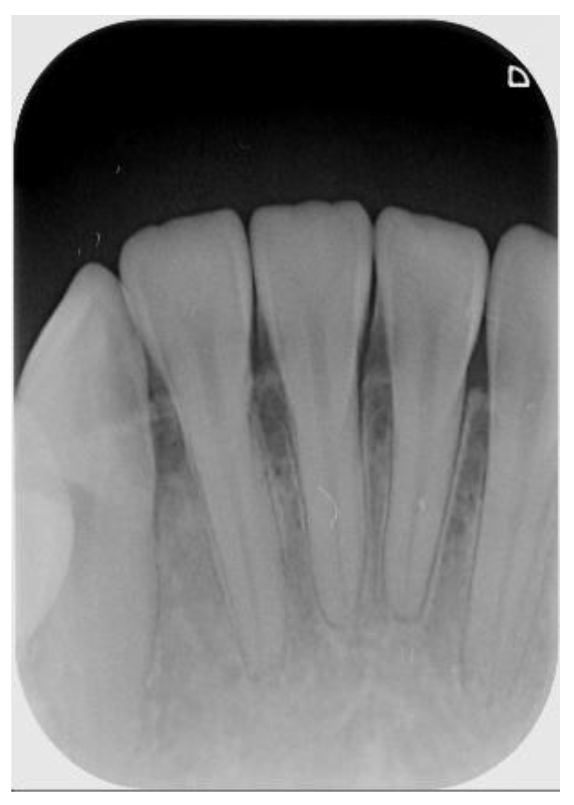 periapical x ray