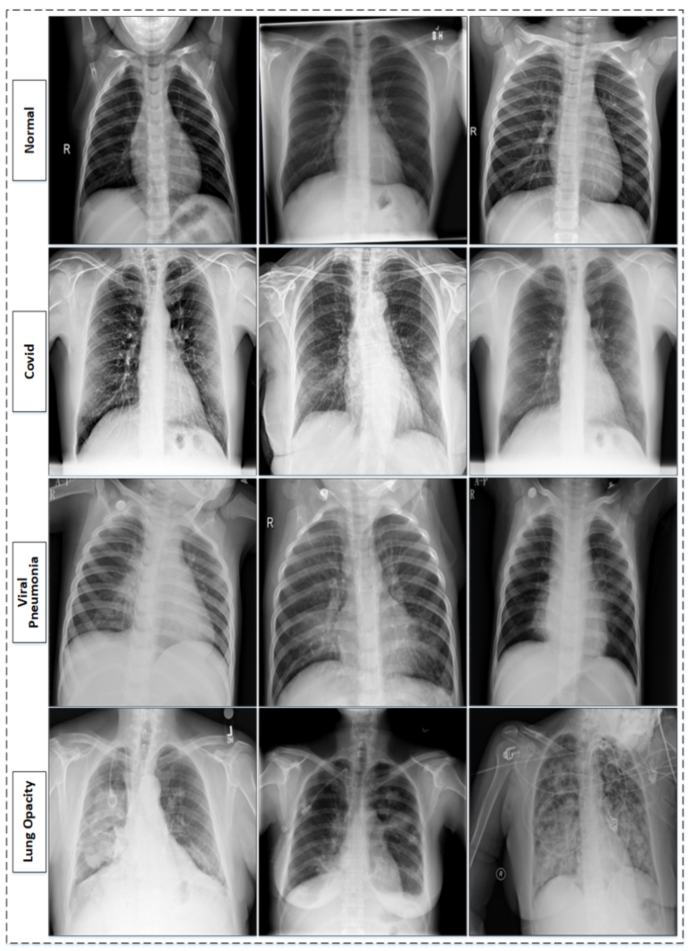 Sensors | Free Full-Text | Chest X-ray Classification for the Detection of  COVID-19 Using Deep Learning Techniques