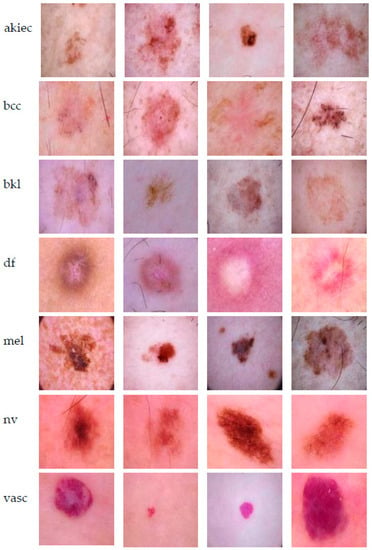 Sensors | Free Full-Text | Skin Lesion Classification Using Collective ...