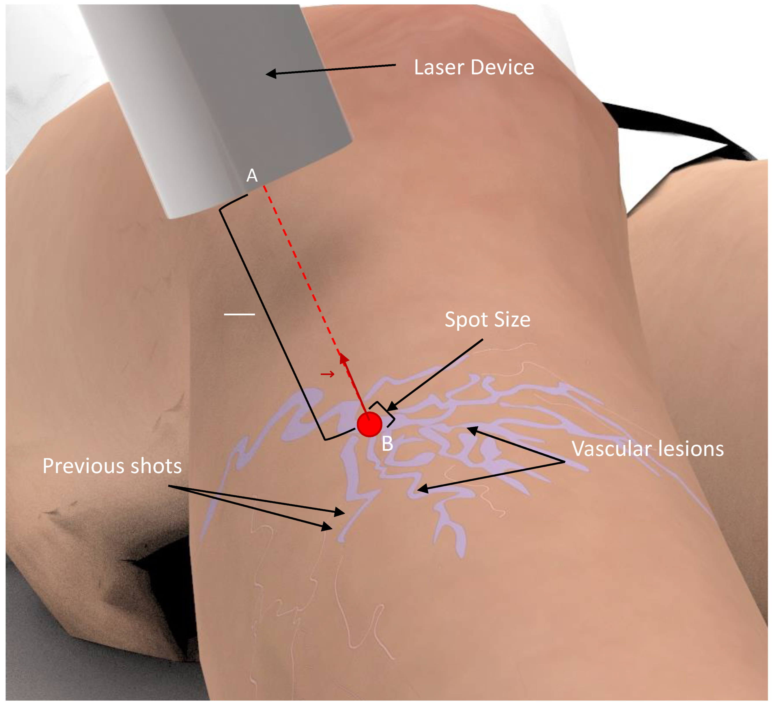 Sensors | Free Full-Text | Characterization of the Workspace and Limits of  Operation of Laser Treatments for Vascular Lesions of the Lower Limbs